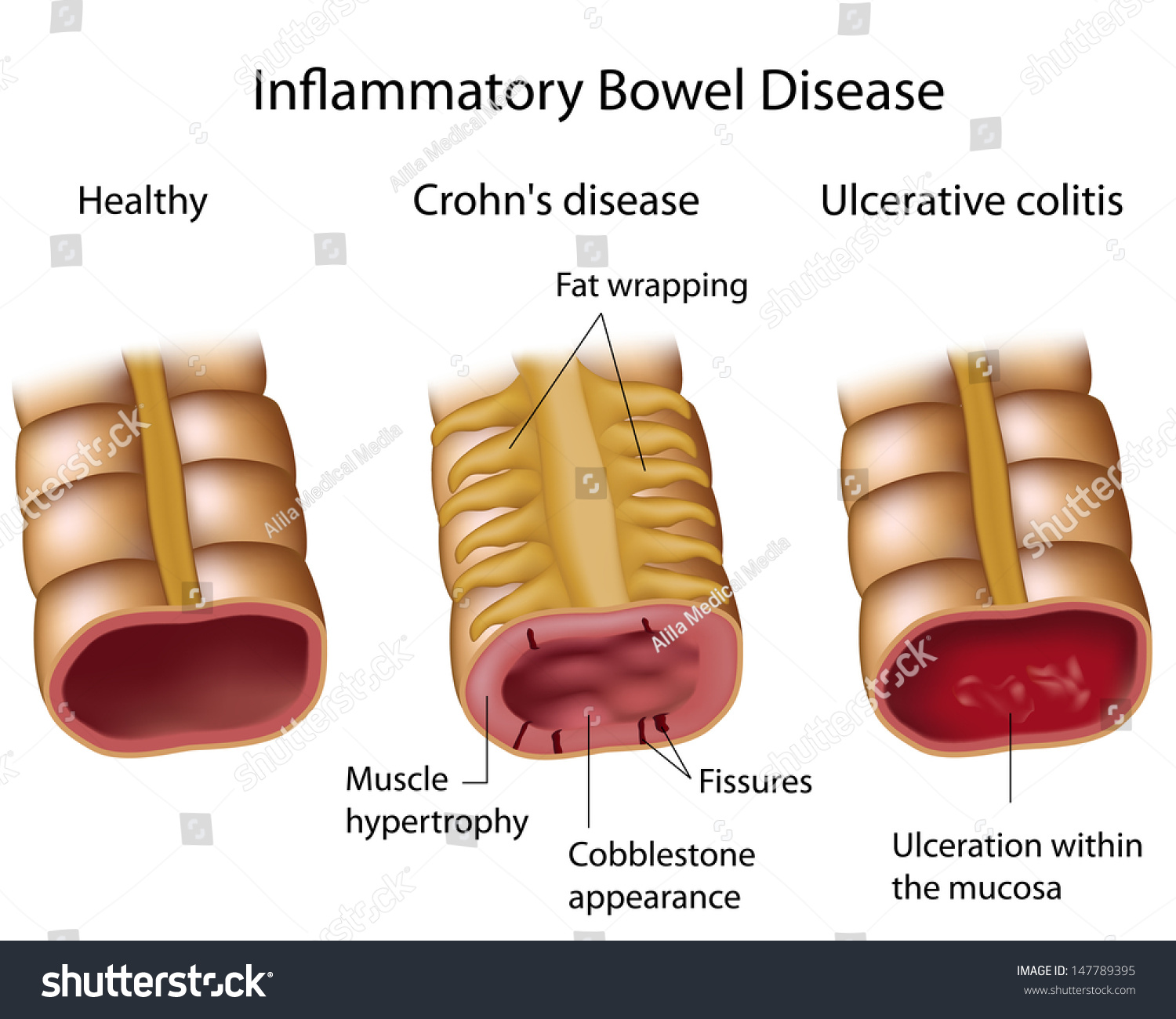 Compare Crohns And Ulcerative Colitis Imagen De Archivo Stock Shutterstock