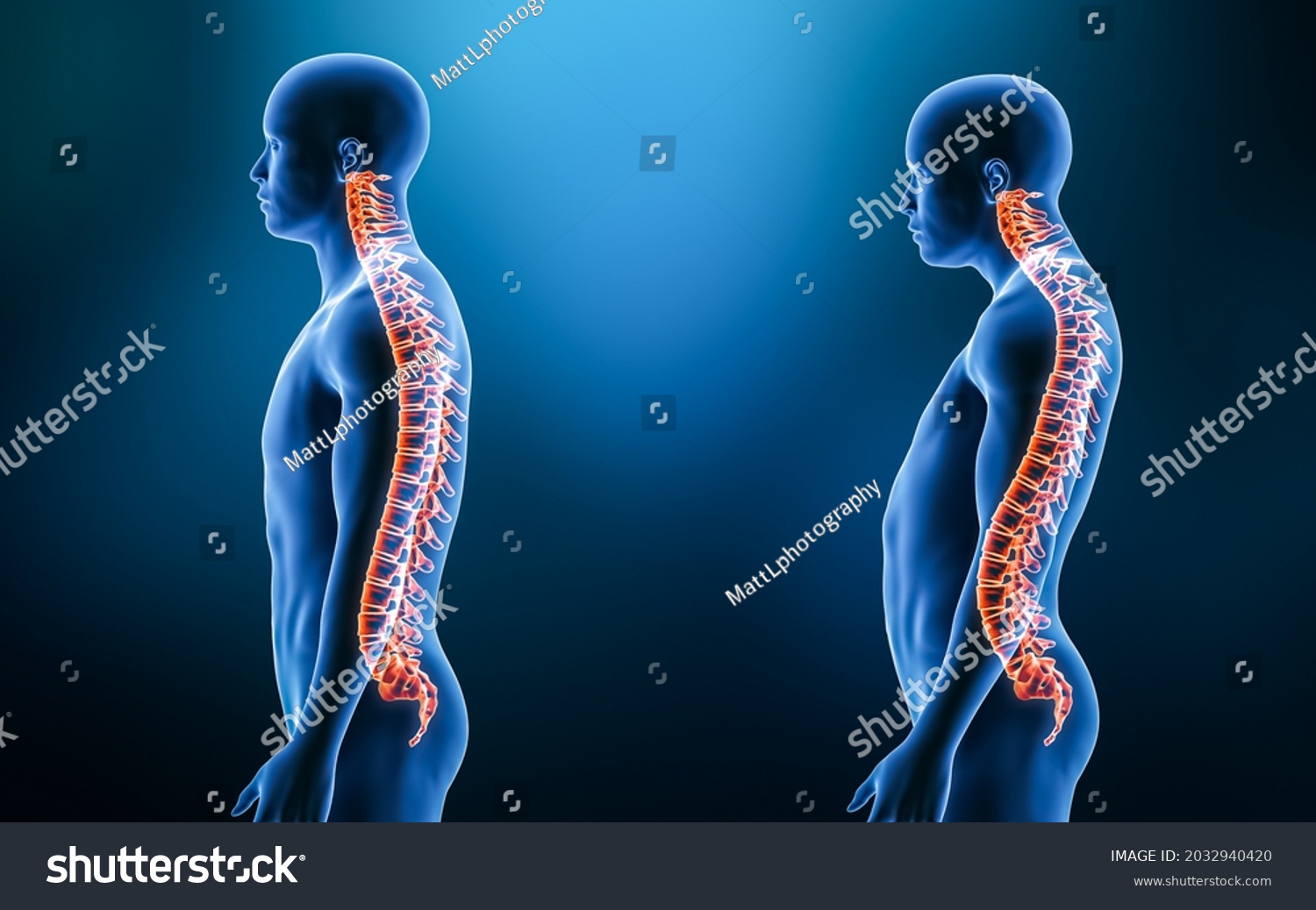 Lordosis Images Stock Photos Vectors Shutterstock