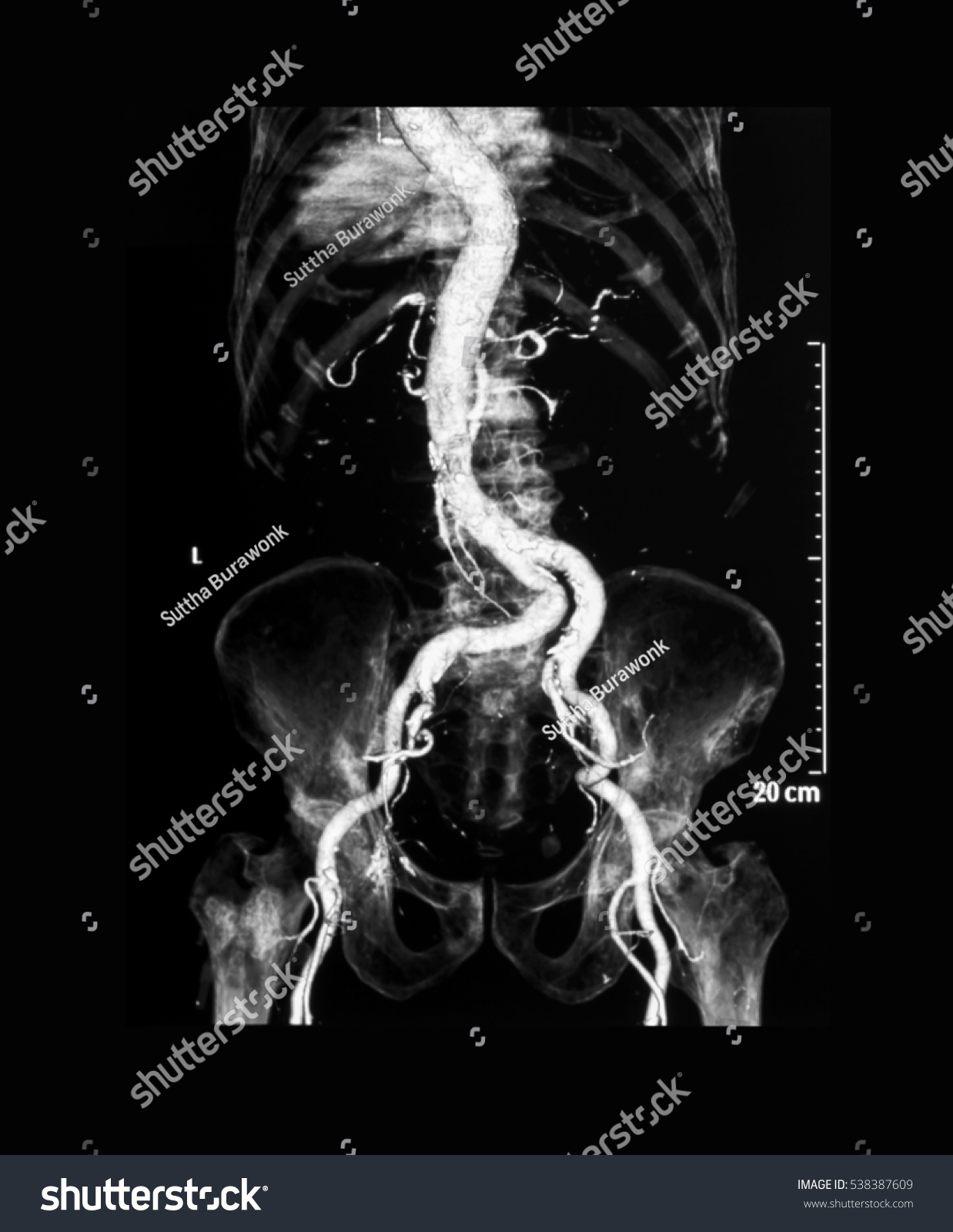 Computed Tomography Angiography Cta Of Abdomen And Pelvic Aorta Stock