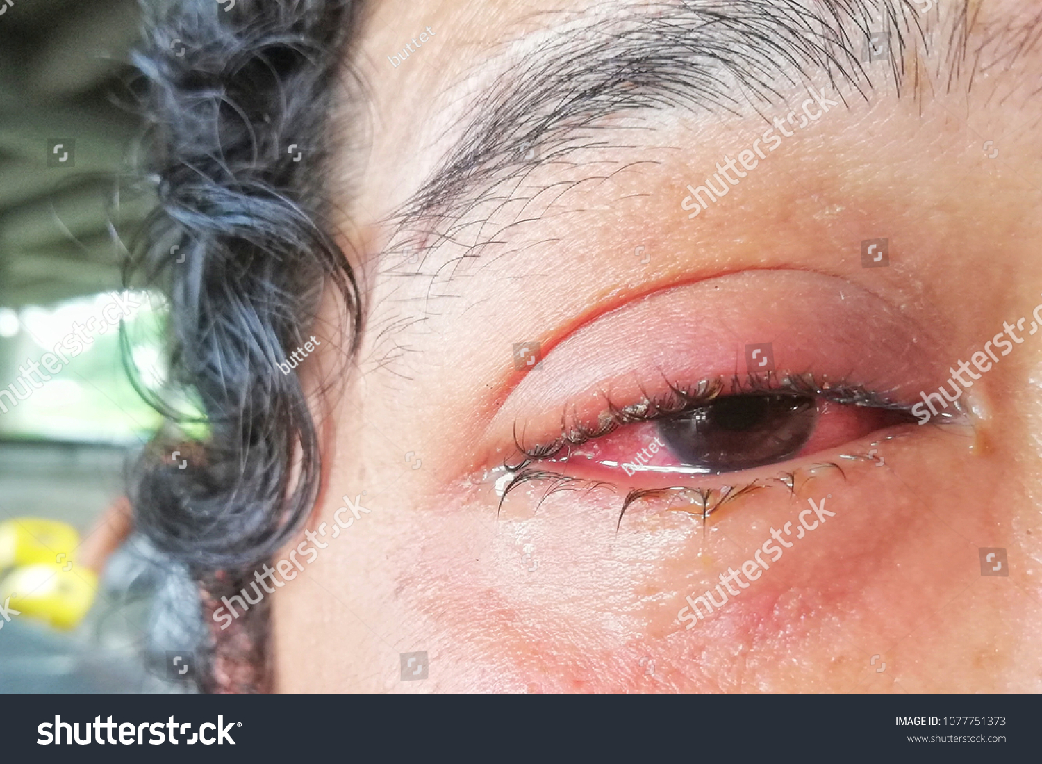 Conjunctivitis Pink Eye Symptoms Stock Photo Shutterstock