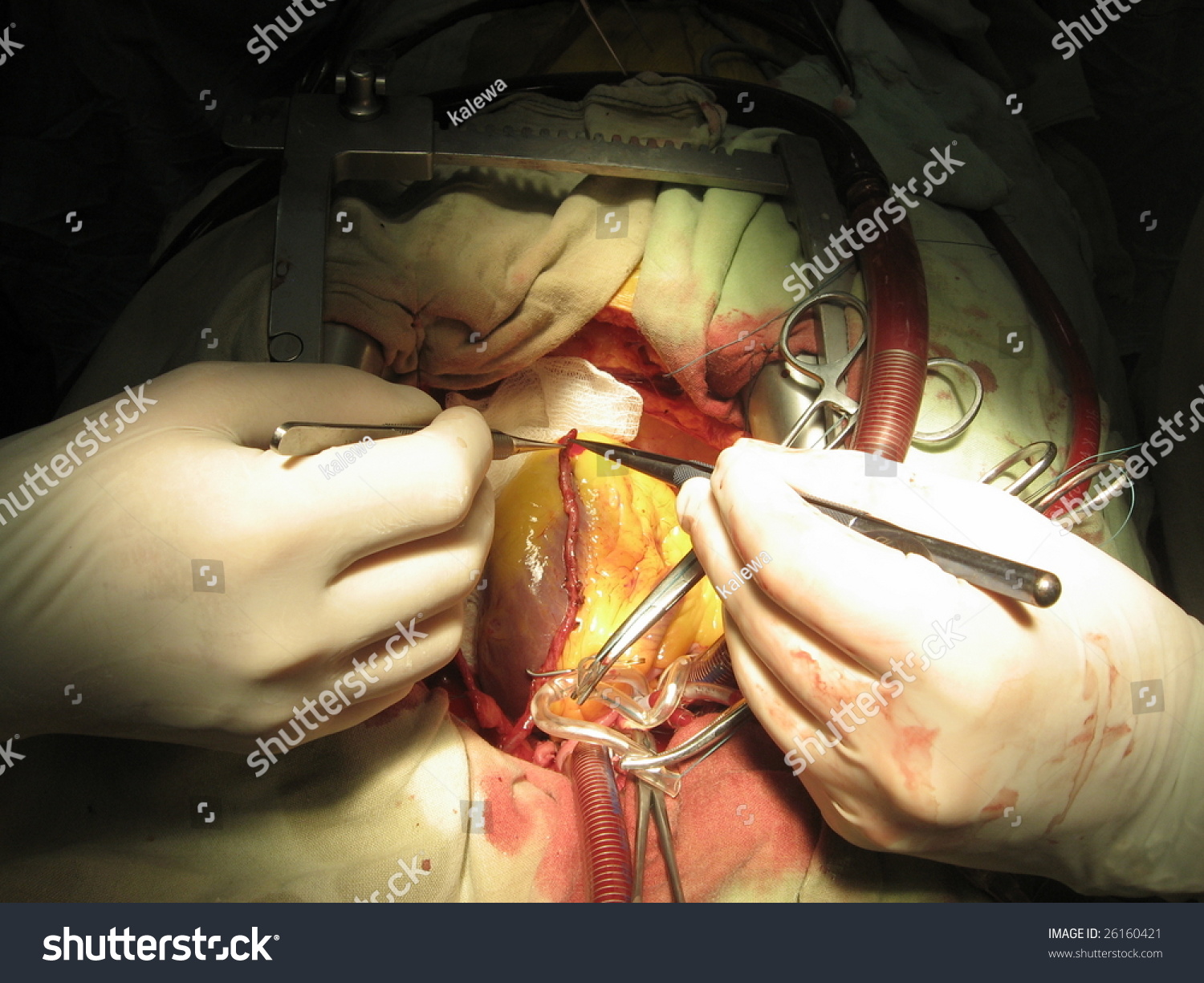 Coronary Artery Bypass Surgery Using Lung Machine Coronary Artery Bypass Surgery Using Lung Machine