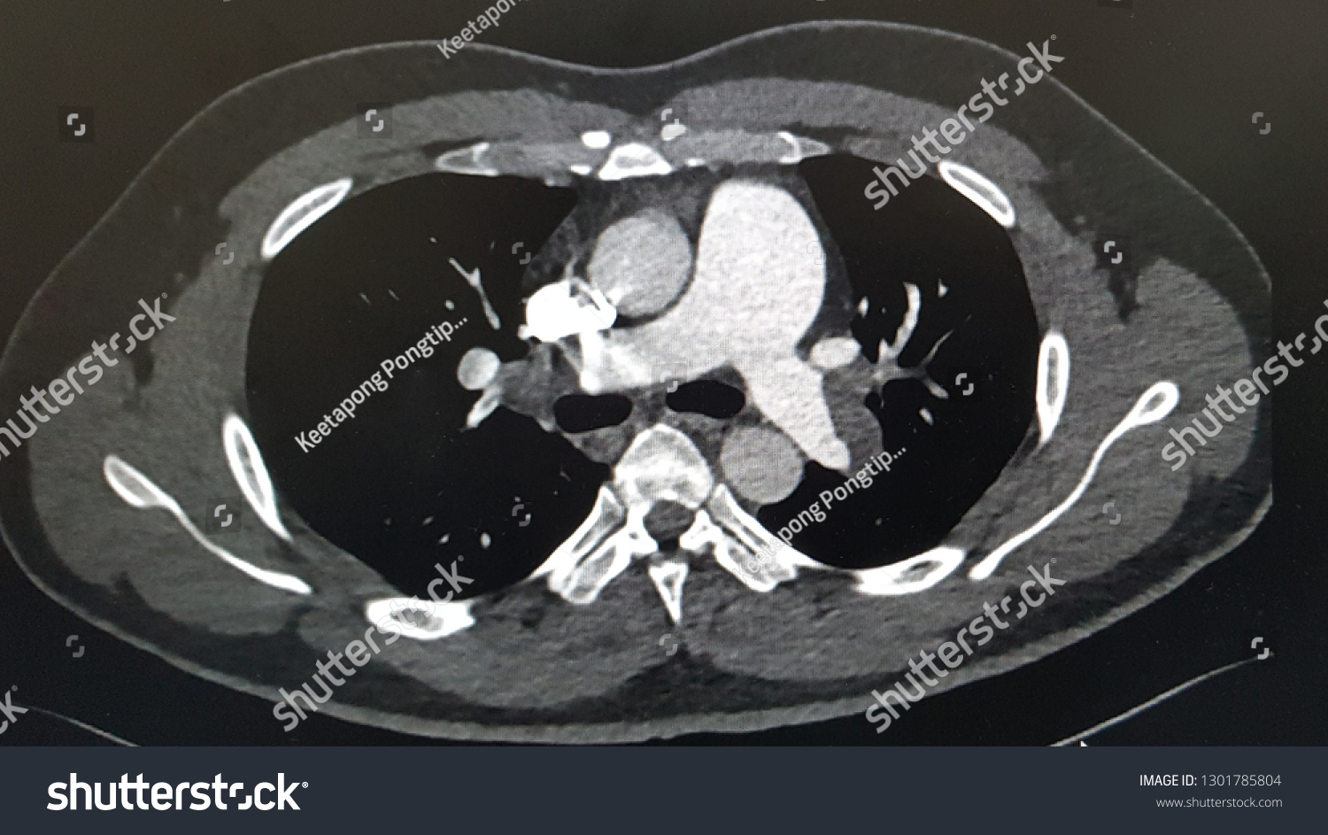 Ct Pulmonary Artery Acute Bilateral Pulmonary Stock Photo Edit Now