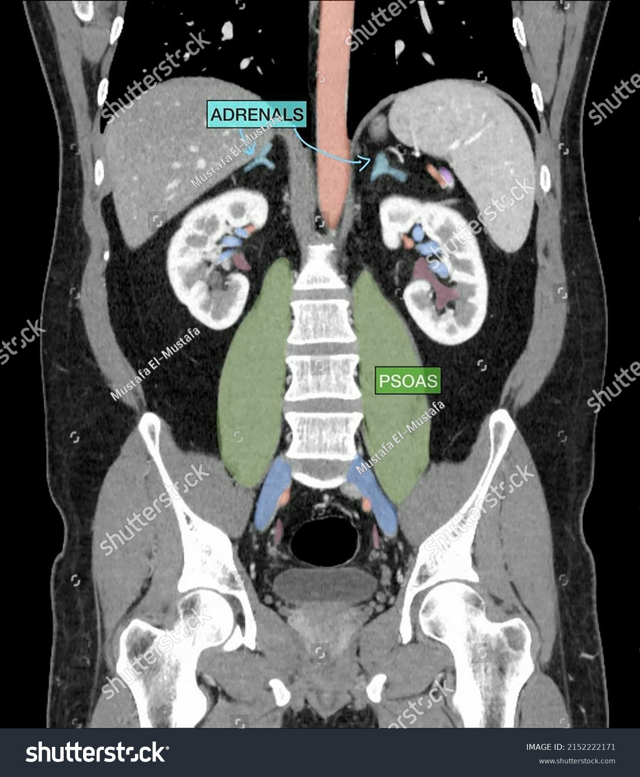 Ct Scan Radiographic Anatomy Abdomen Pelvis Stock Photo 2152222171