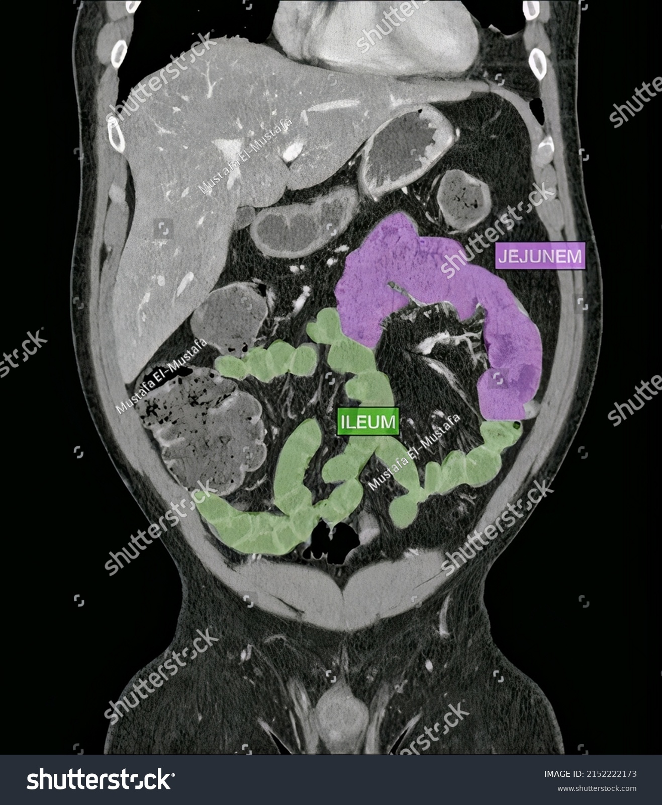 Ct Scan Radiographic Anatomy Abdomen Pelvis Stock Photo