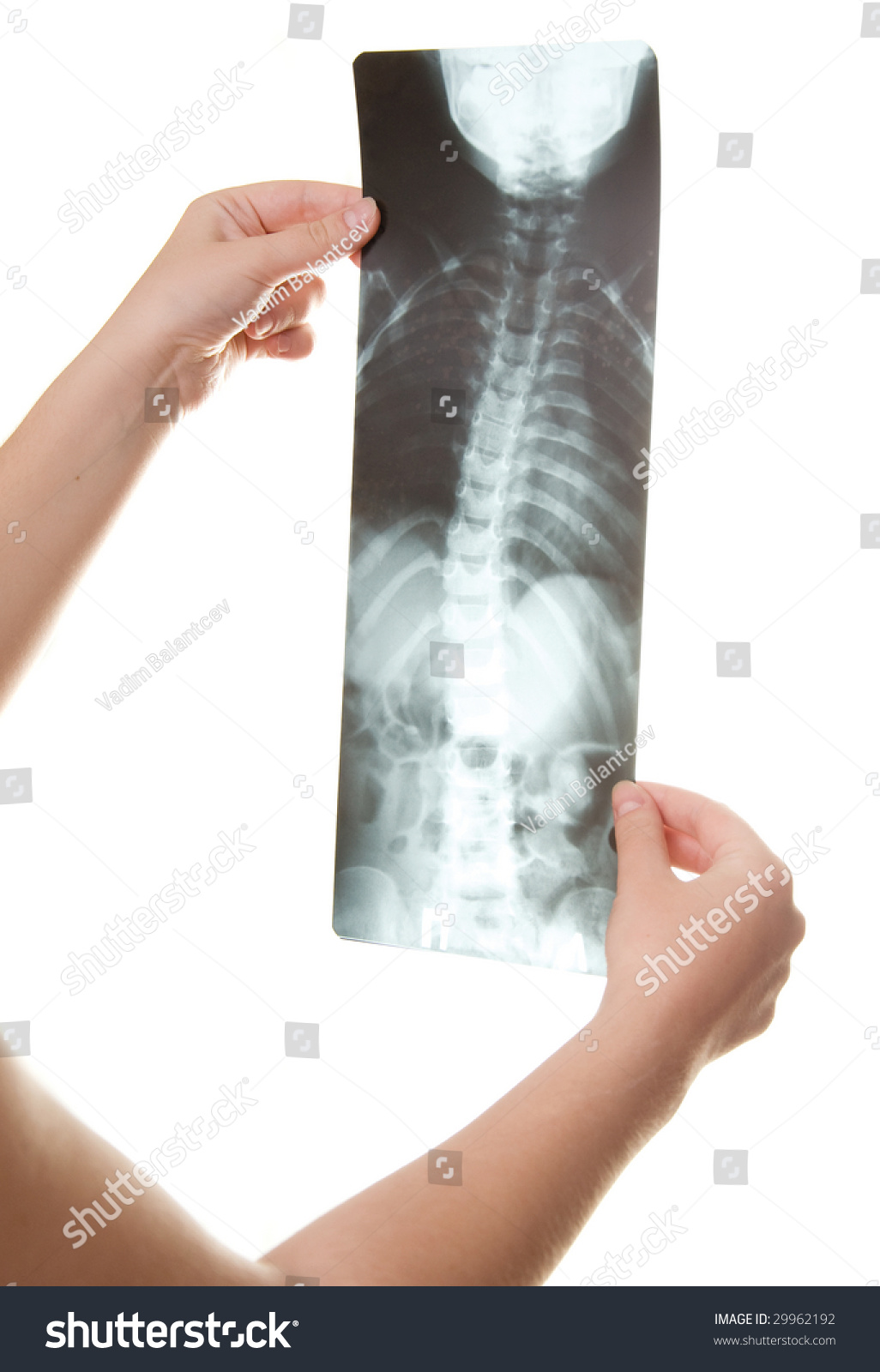 Curvature Spine Roentgenogram Stock Photo Shutterstock