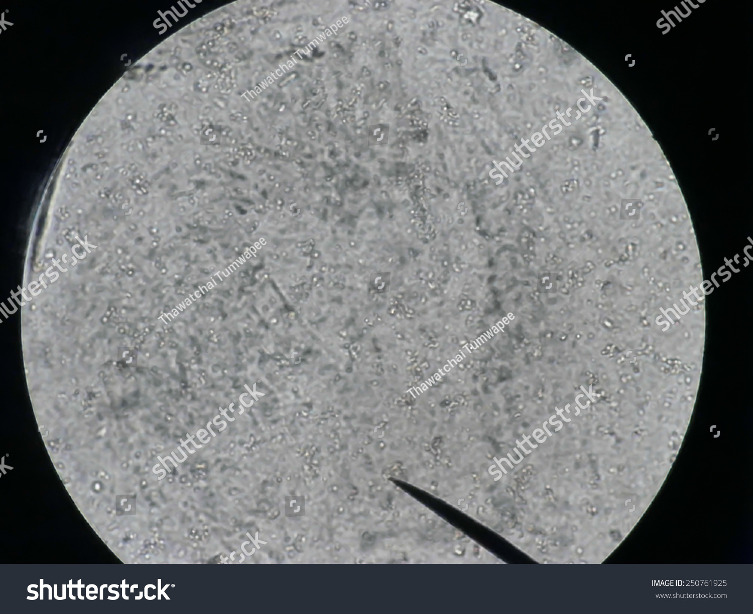 Cytology Smear Of Pleural Effusion Showing Candida Fungi Organism