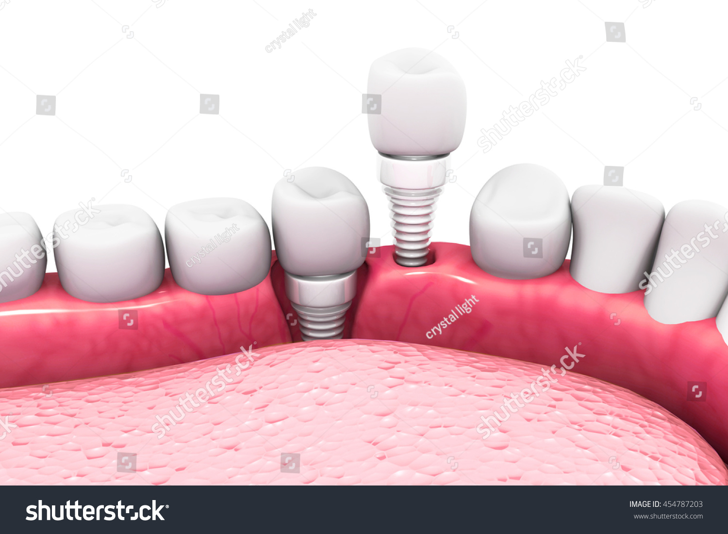 Dental implant structure.3D render Dental implant structure.3D render