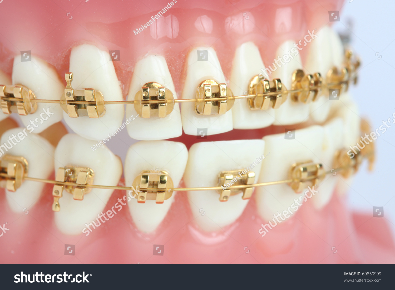 Denture With Braces Stock Photo 69850999 : Shutterstock