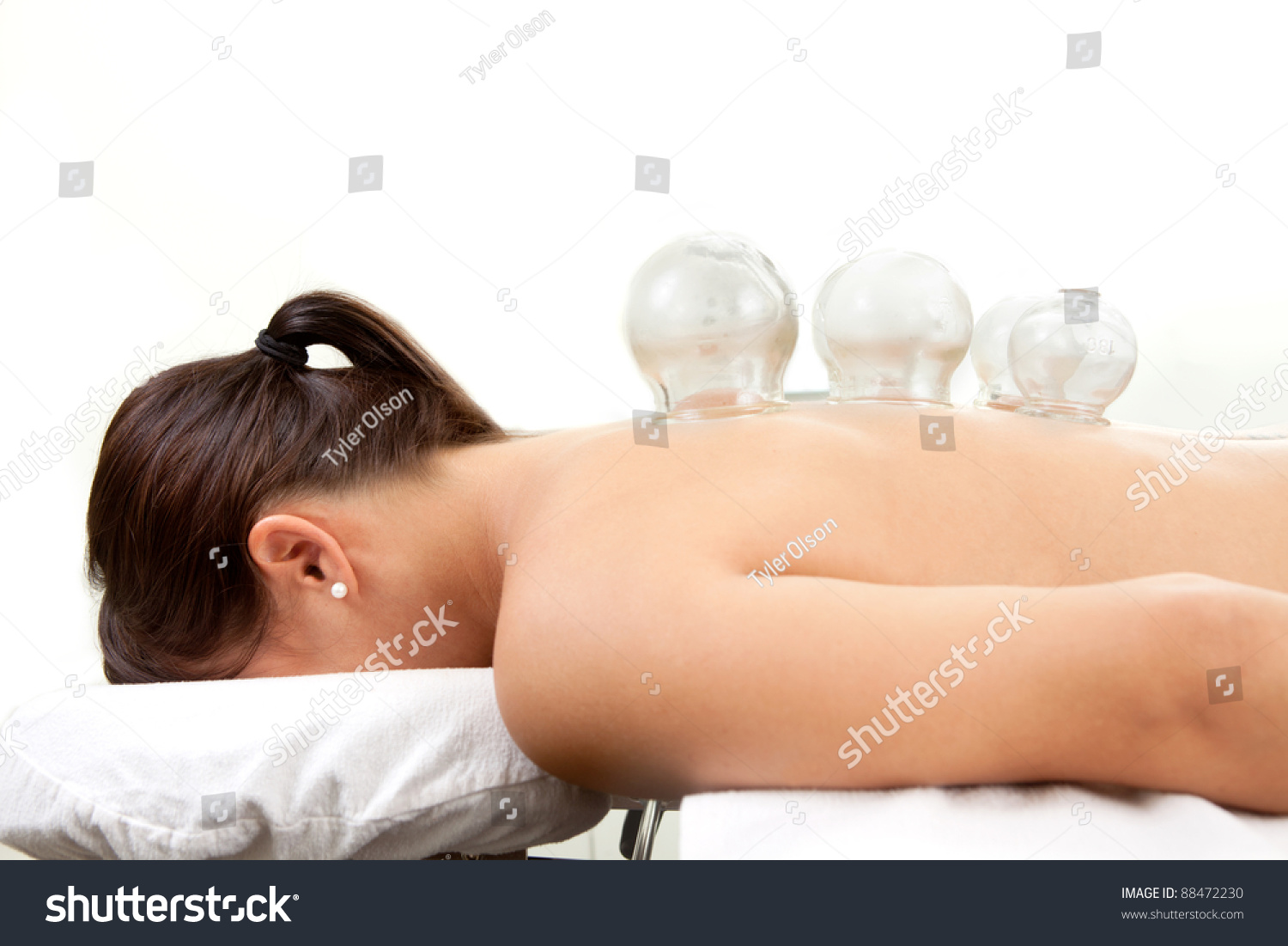 Image result for Giác hơi – Cupping Therapy