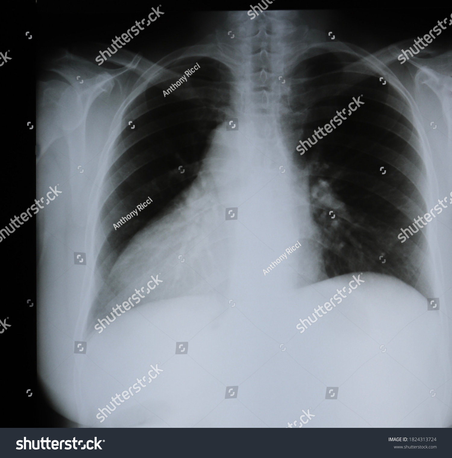 Dextrocardia Chest Xray That Shows Rare Stock Photo Edit Now 1824313724