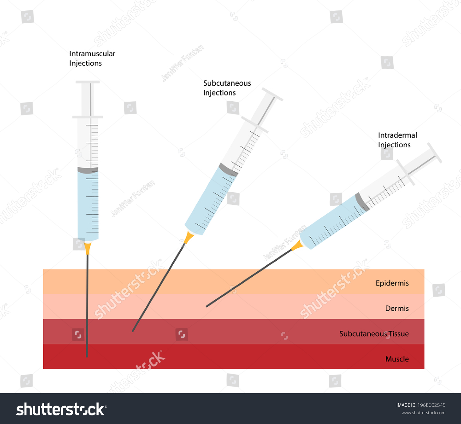 Différentes injections d Angles de seringue injections illustration