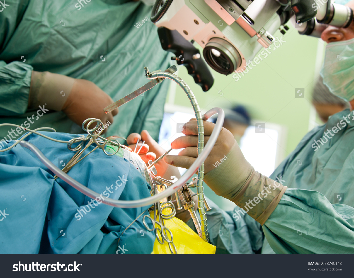 Doctors Performing Brain Surgery With Microscope Stock Photo 88740148