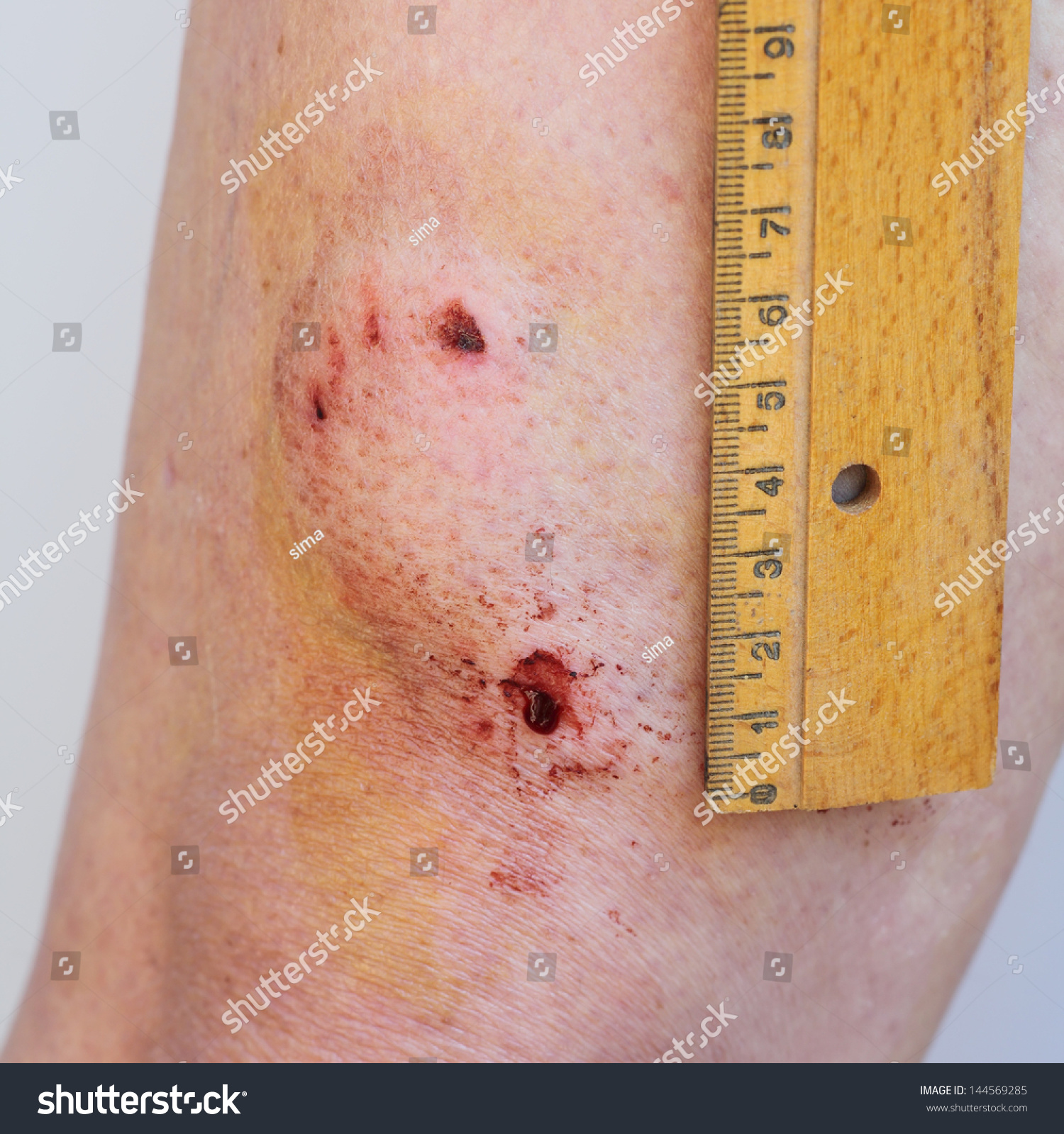 Dog Bite Puncture Wound On Human Leg Stock Photo 144569285 Shutterstock