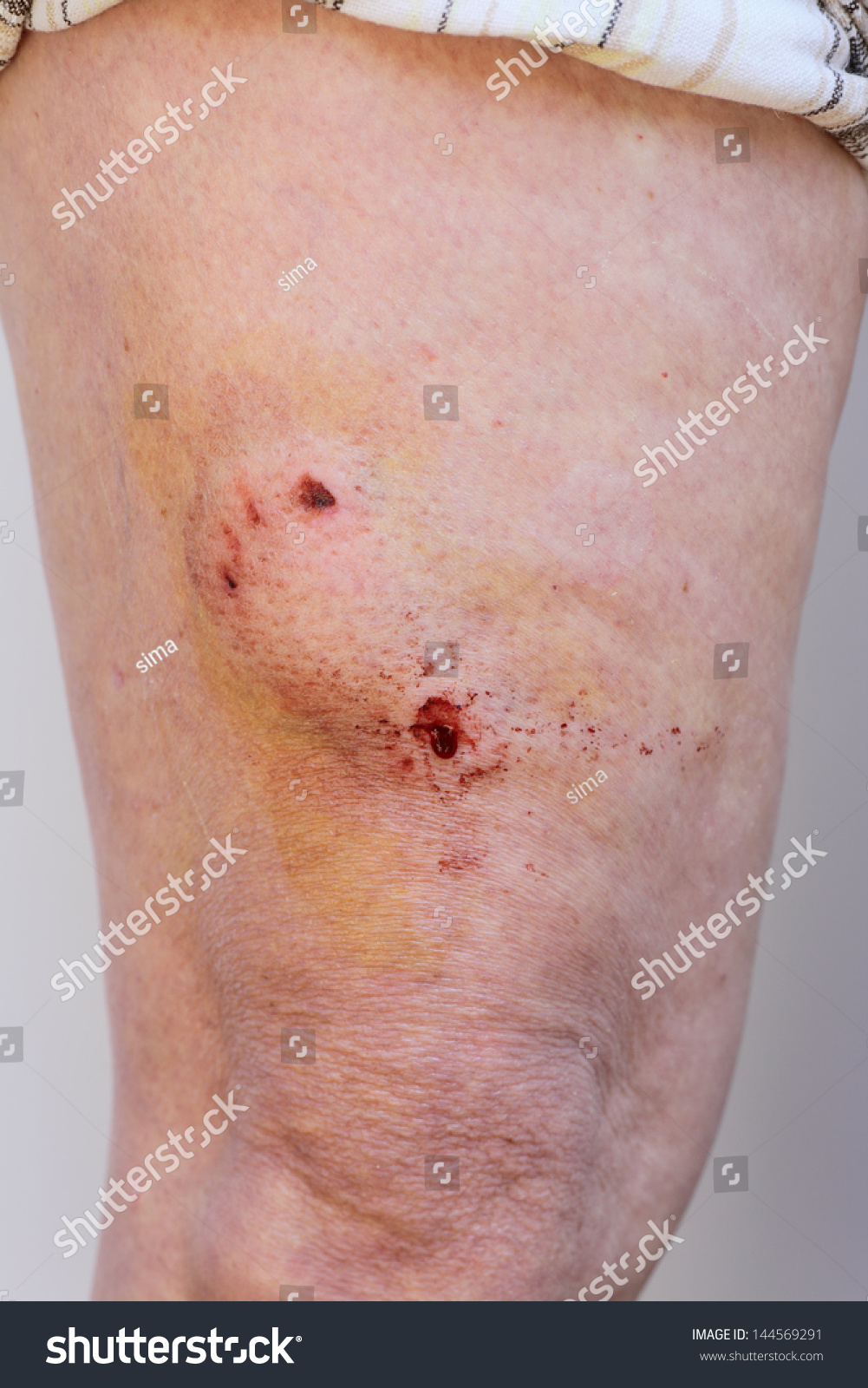 dog-bite-puncture-wound-on-human-leg-stock-photo-144569291-shutterstock