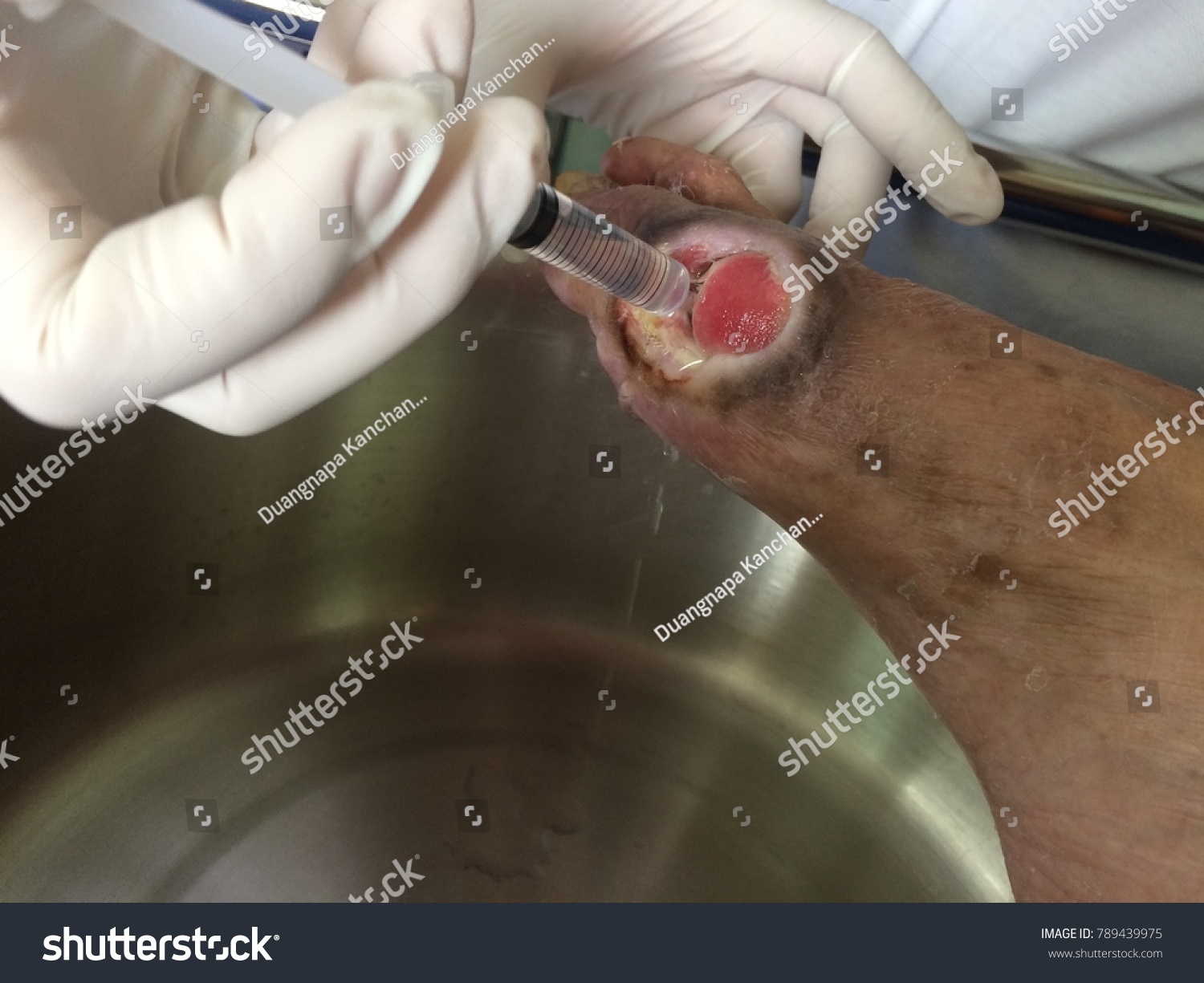 Dressing Wound Infected Wound Diabetic Foot Stock Photo Edit Now