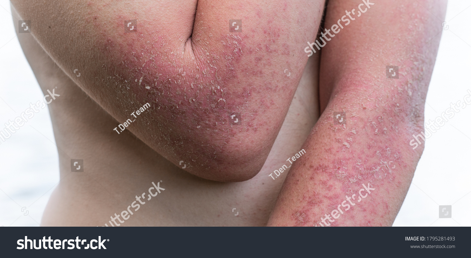 Dyshidrotic Autoimmune Eczema Patient Concept Health Foto Stock Editar Agora