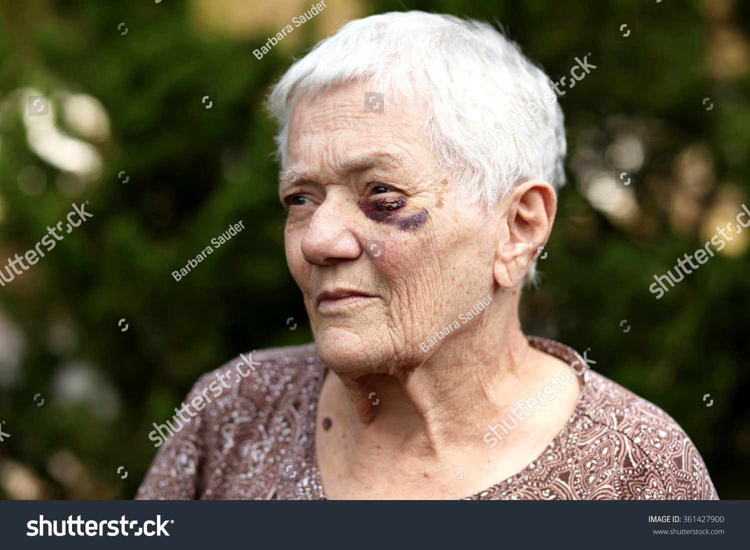 Elderly Woman With Bruised Eye. Stock Photo 361427900 : Shutterstock