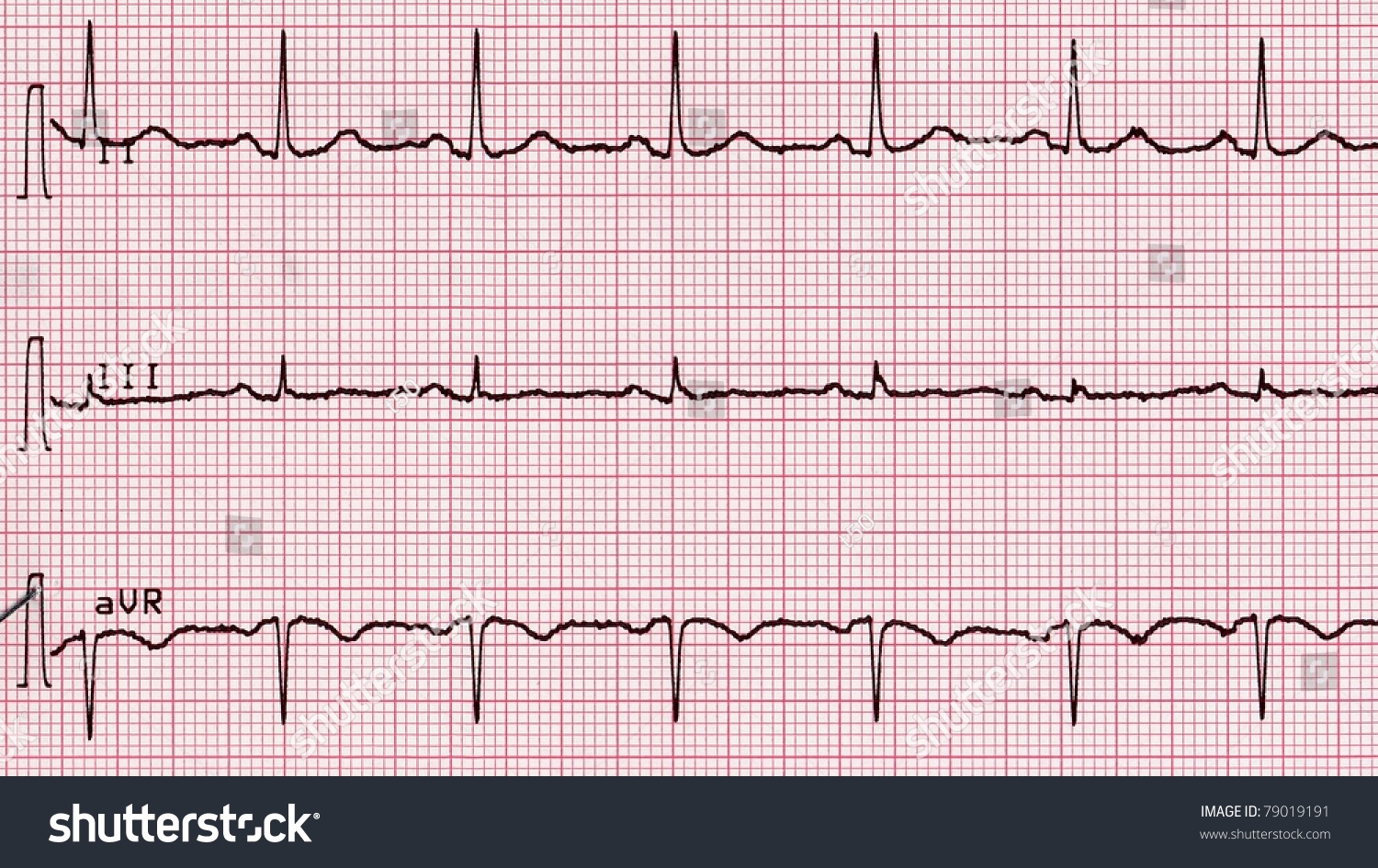 Electrocardiography (Aka Ekg Elektrokardiogramm) To Measure Heartbeat