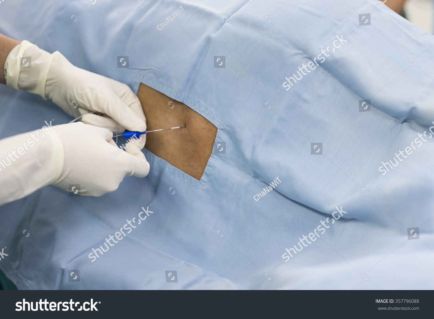 Epidural Nerve Block Stock Photo 357796088 Shutterstock