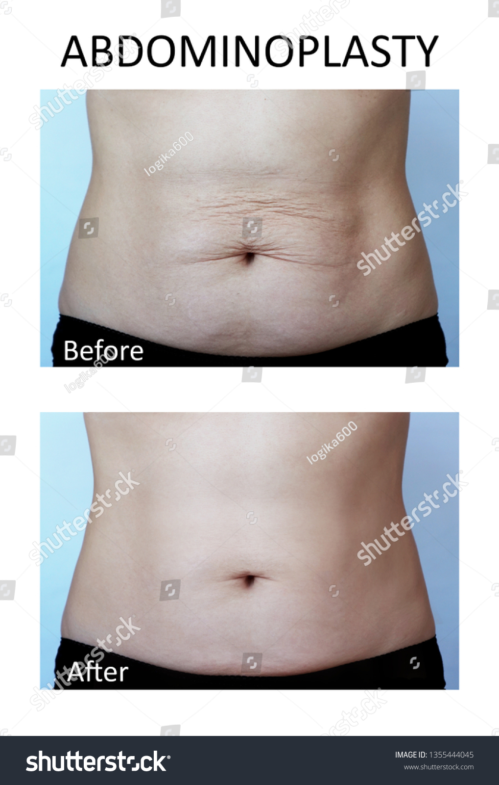 Female Abdomen Before After Abdominoplasty Stock Photo Edit Now