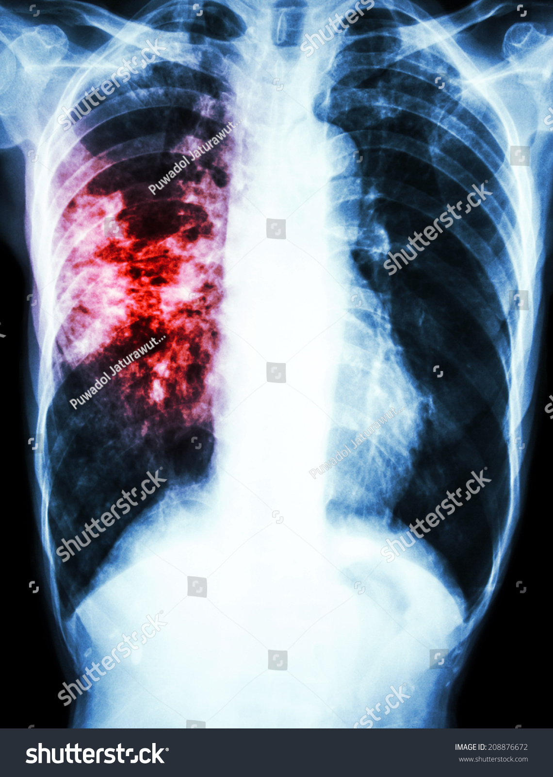 Film Chest Xray Show Alveolar Infiltrate库存照片208876672 Shutterstock