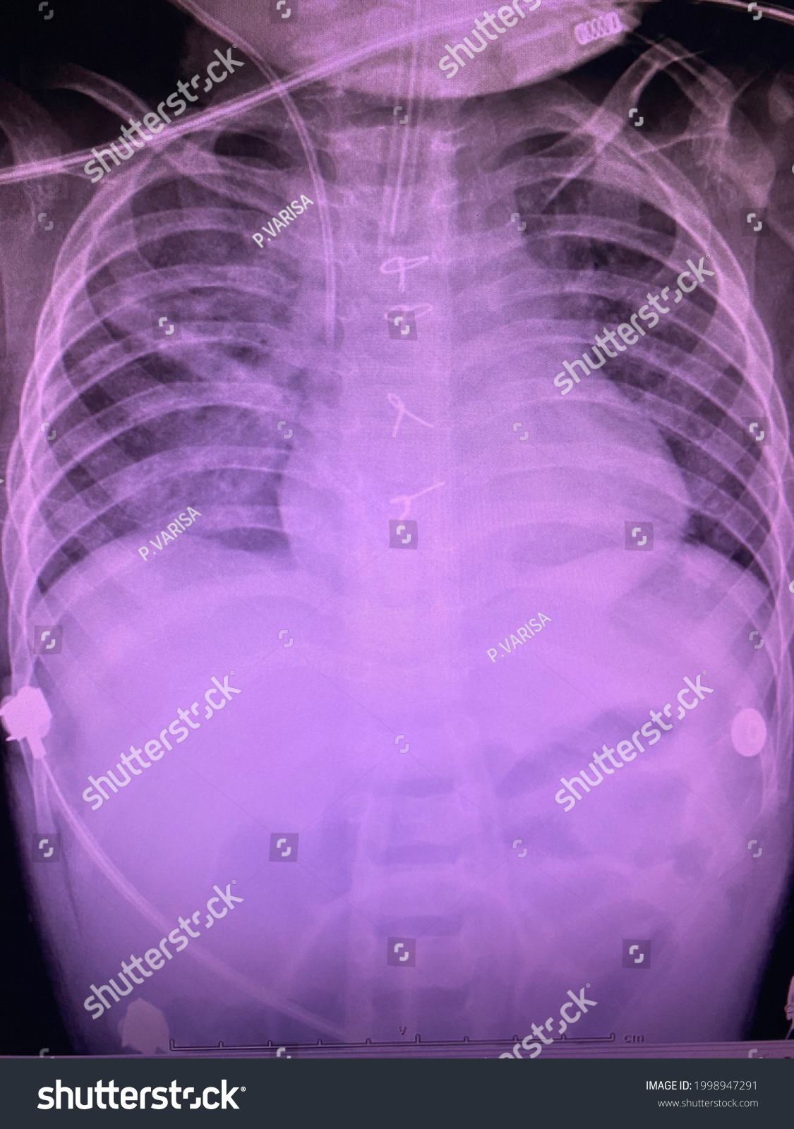 Film Xray Show Pleural Effusion Pulmonary ภาพสตอก 1998947291