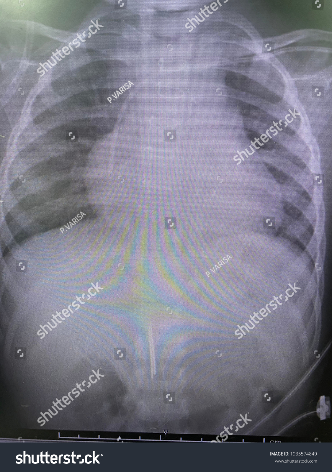 Film Xray Show Pulmonary Congestion Infiltration Stock Photo 1935574849