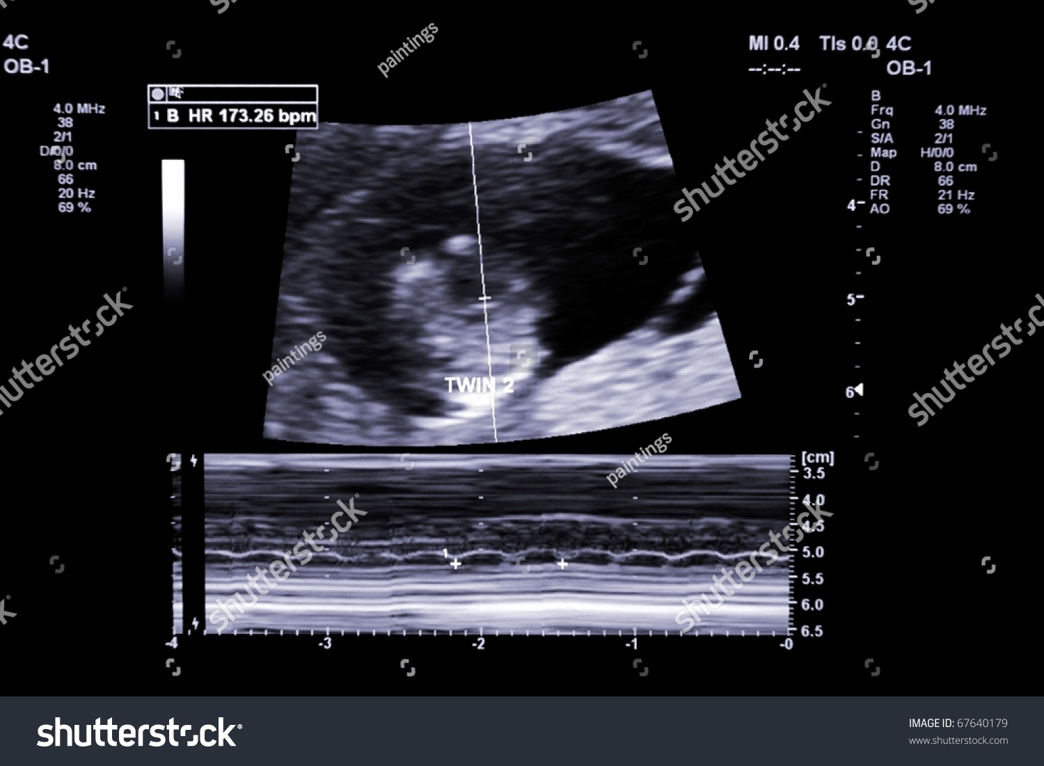 First Trimester Ultrasound Baby Xray Fraternal Stock Photo ...