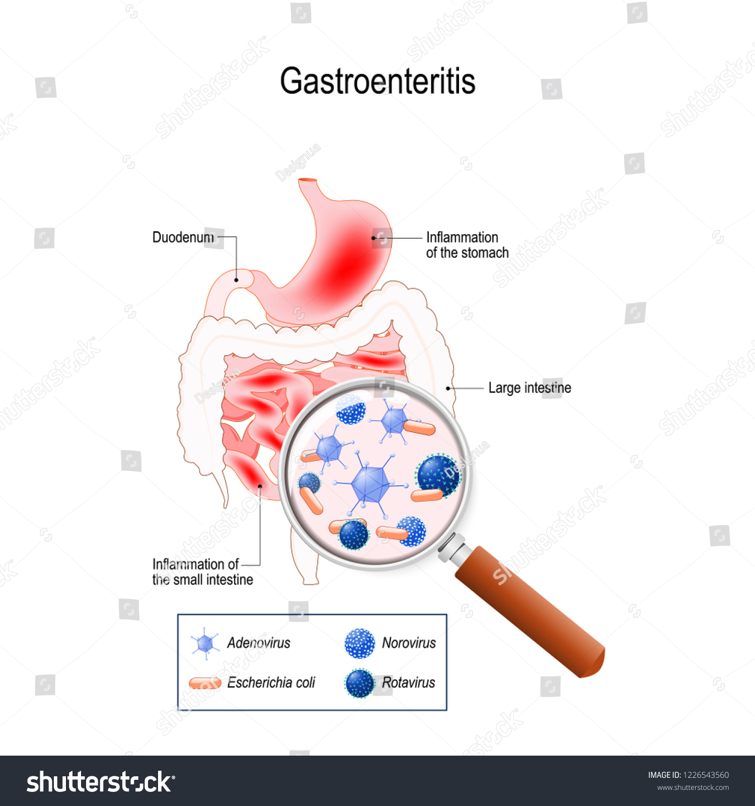 Gastroenteritis Infectious Diarrhea Inflammation Gastrointestinal Tract