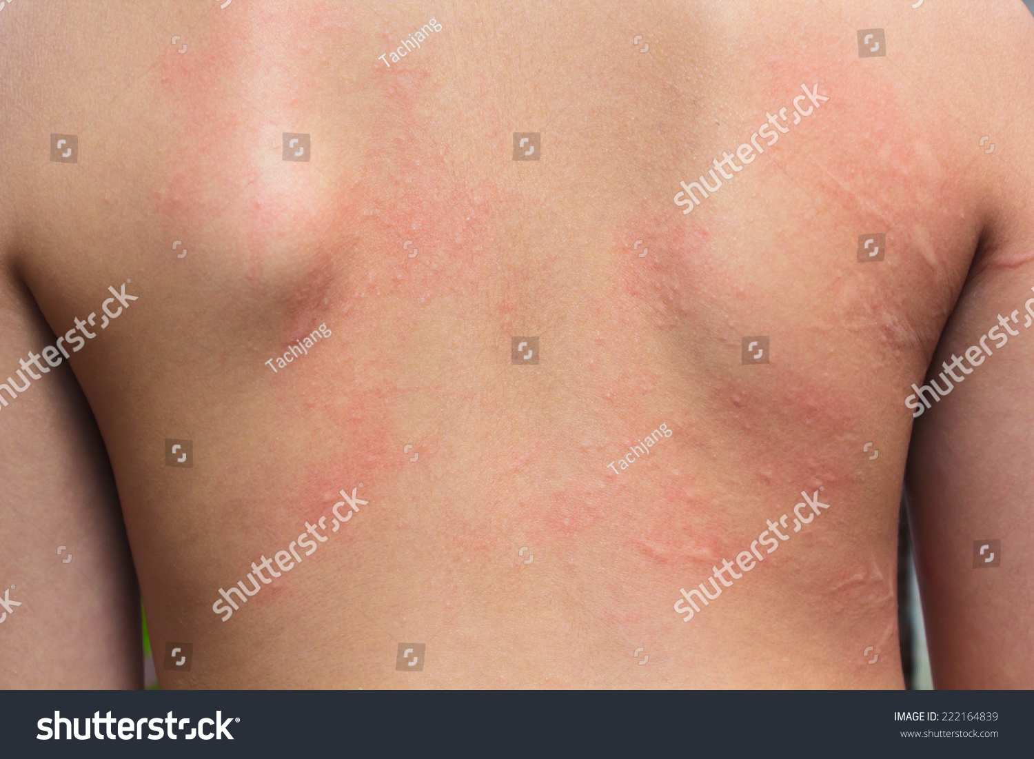 Human Skin Presenting An Allergic Reaction Allergic Rash Stock Photo