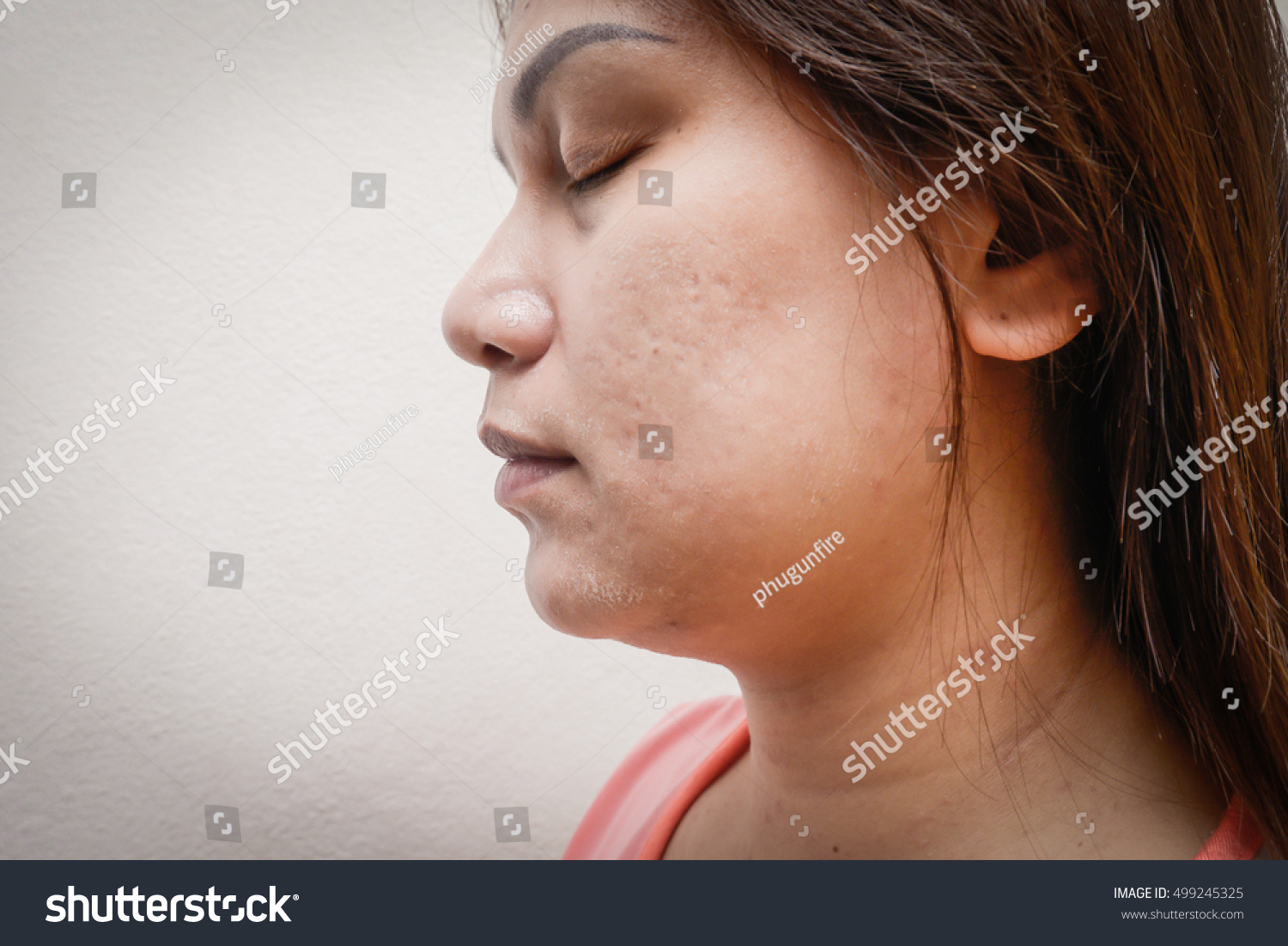 Human Skin Presenting Allergic Reaction Allergic Stock Photo Edit Now