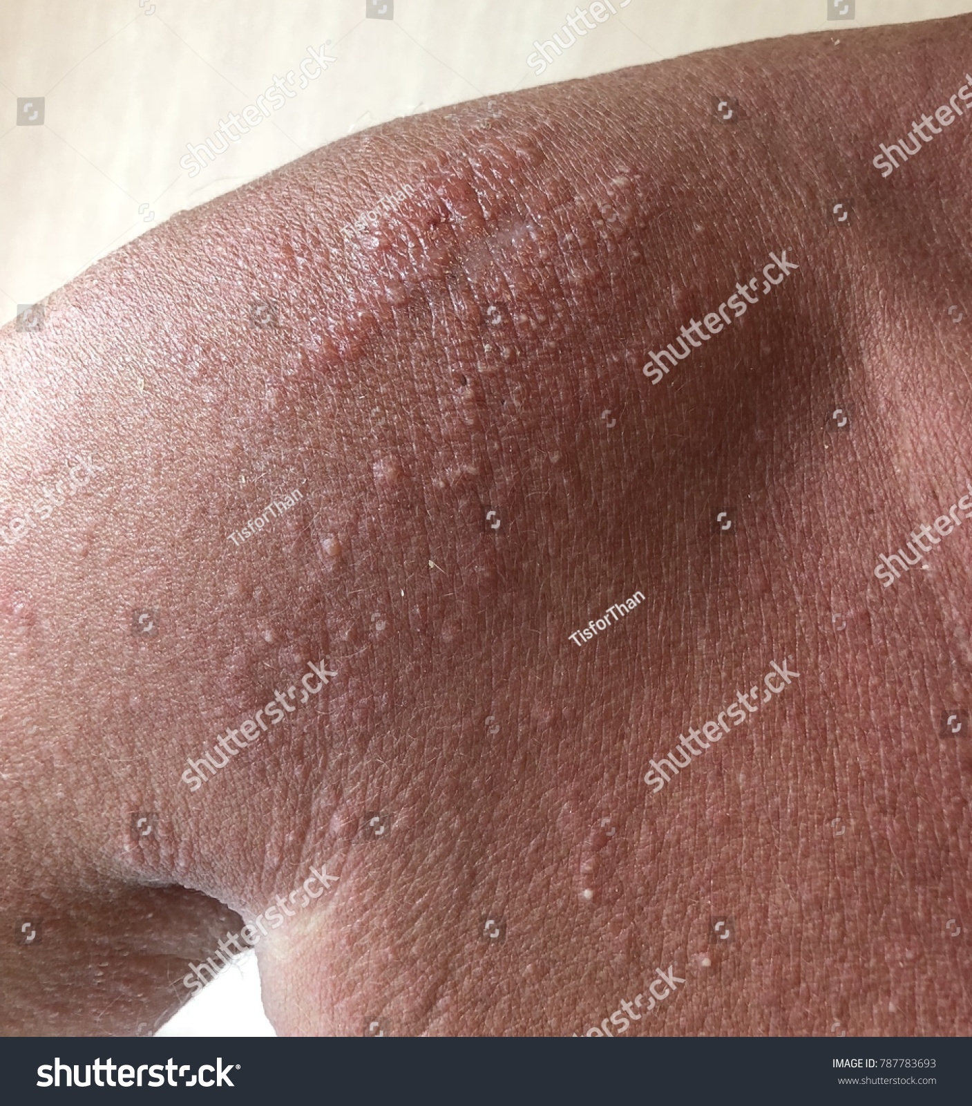 Ill Defined Erythematous Tiny Papule Allergic Foto Stock Editar Agora