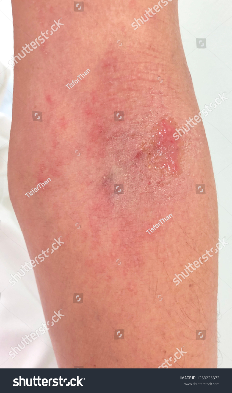 Illdefined Itchy Rash Cubital Fossa Case Foto De Stock