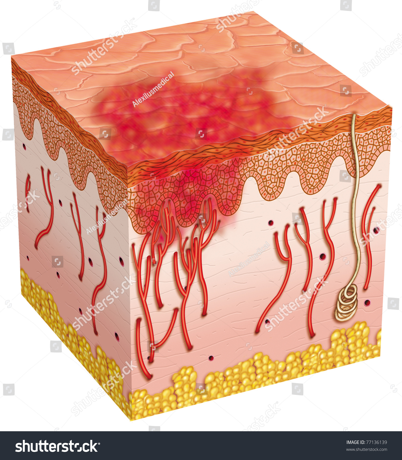 Illustration Of Skin Affected By A Bruise - 77136139 : Shutterstock