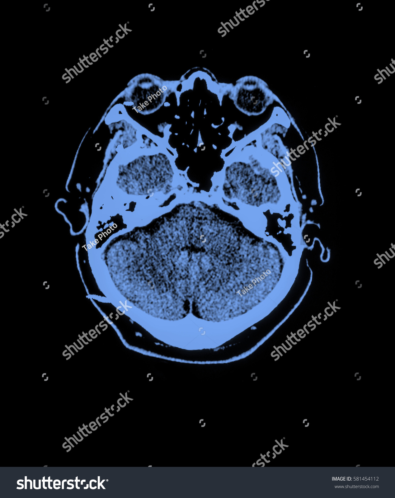 Imaging Brain On Xray Mri Mra Stock Photo Shutterstock