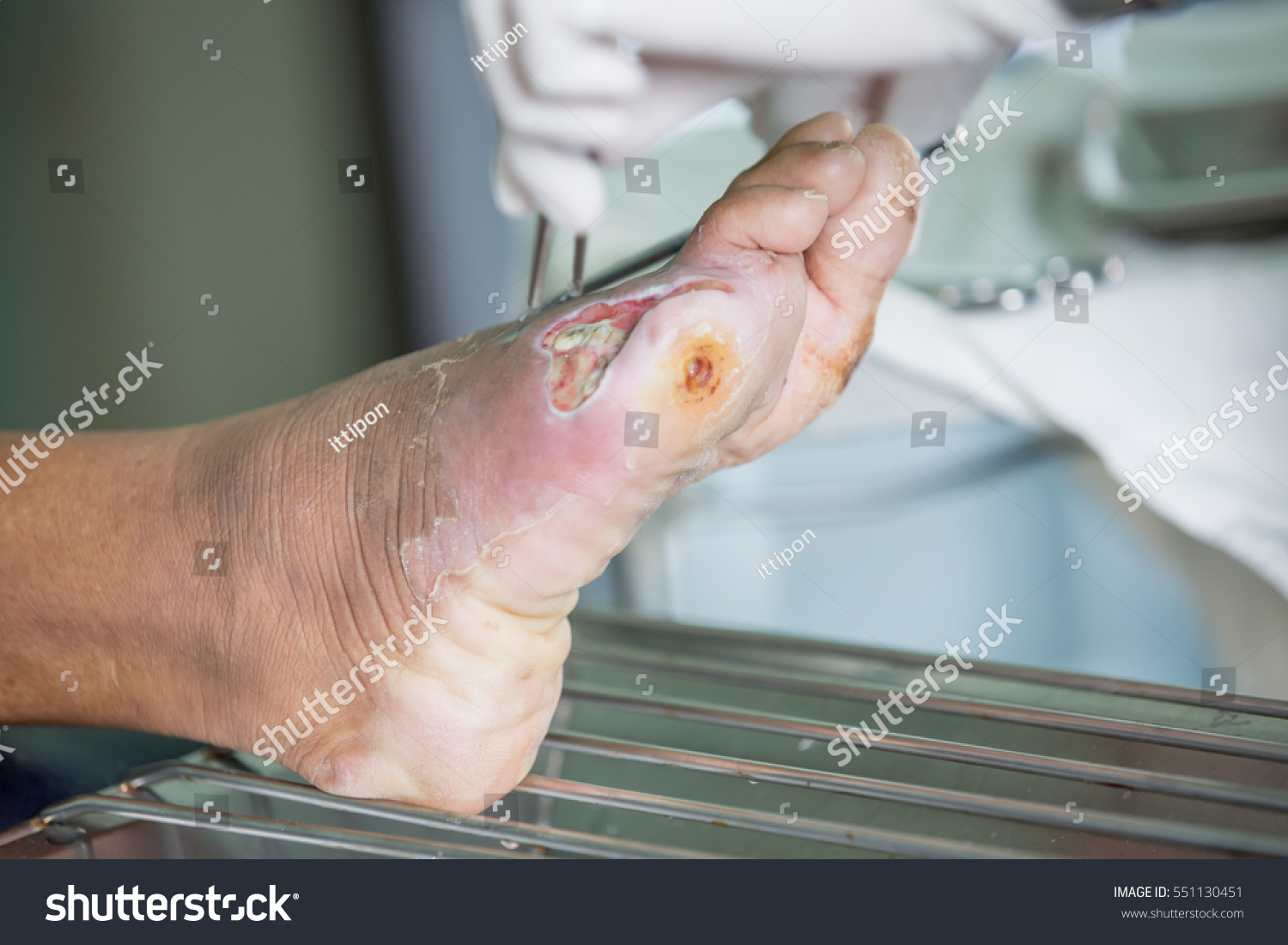 Infected Wound Of Diabetic Foot Stock Photo 551130451 : Shutterstock