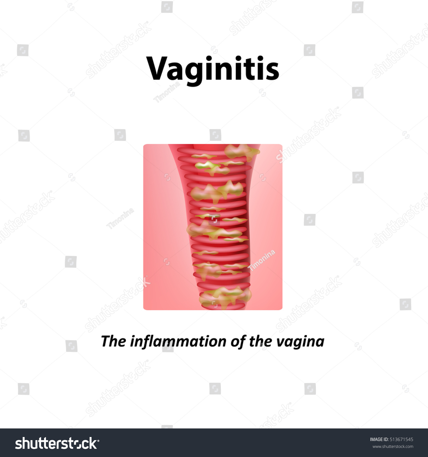 Inflammation Vagina Vaginitis Infographics Illustration On ilustración