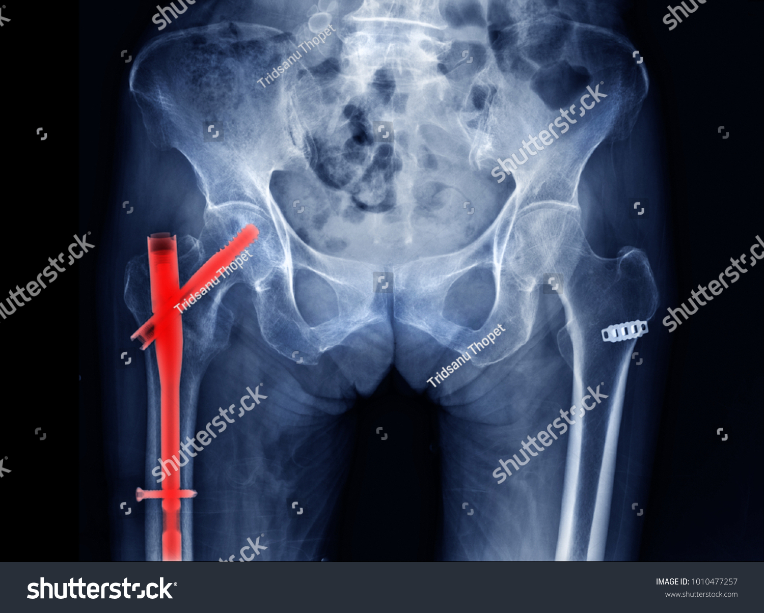 Intertrochanteric Fractures Post Operation Internal Fixation Stock