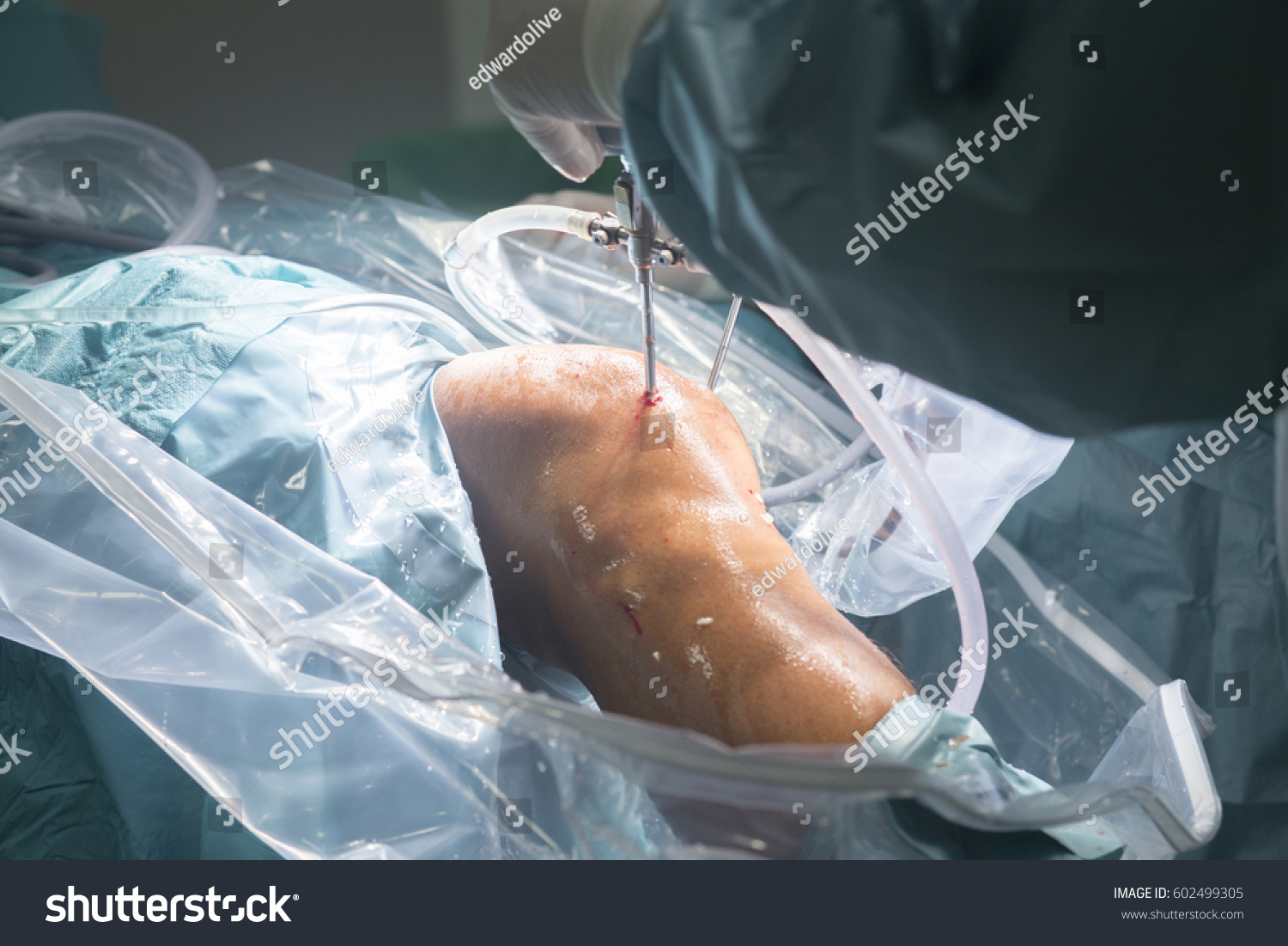 Knee Keyhole Surgery Hospital Arthroscopy Operation Stock Photo