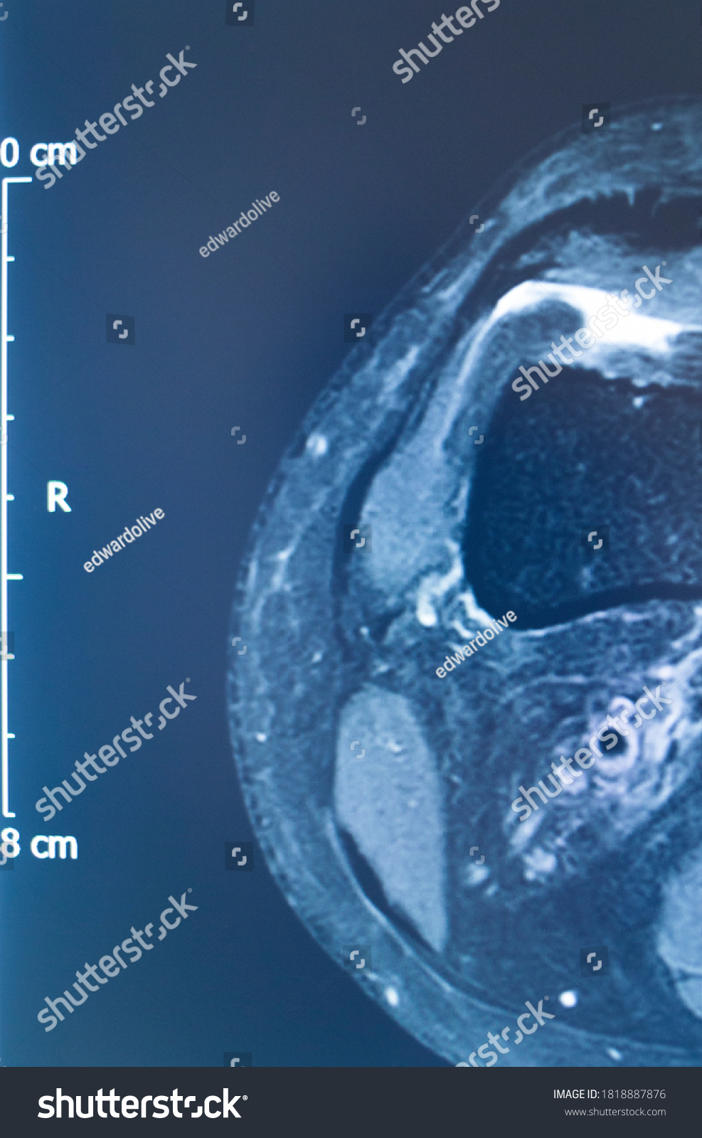 Knee Sports Injury Mri Mcl Grade Stock Photo Shutterstock