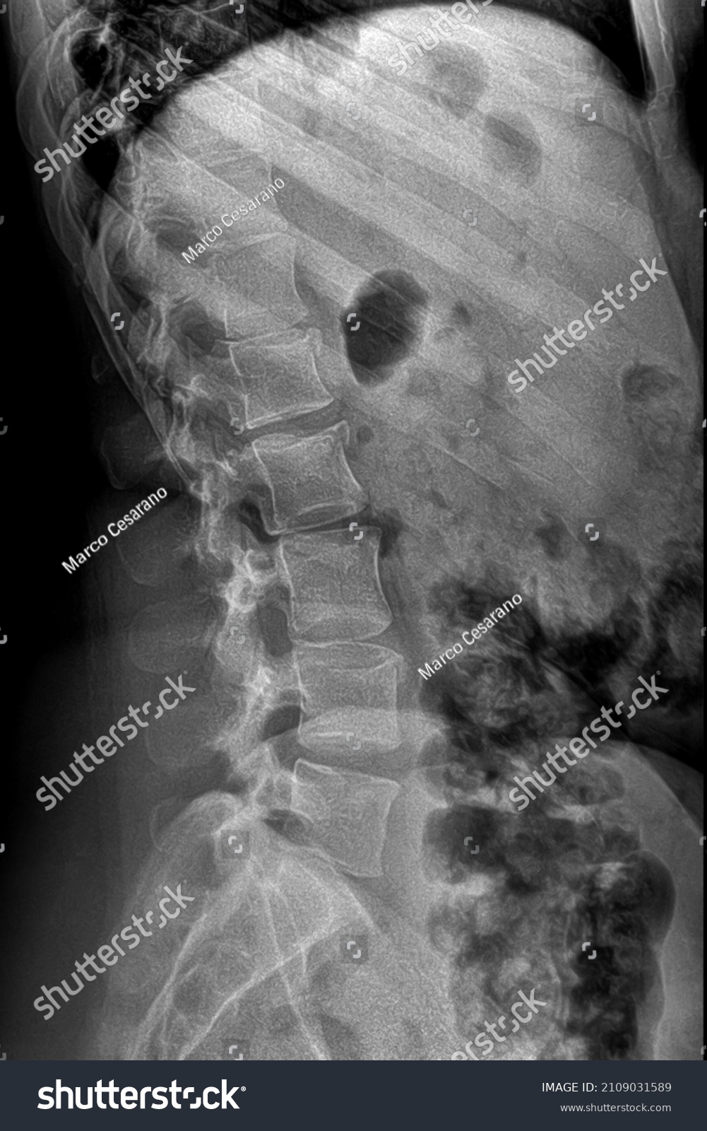 Lumbar Spine Radiography Laterallateral Projection Stock Photo Shutterstock