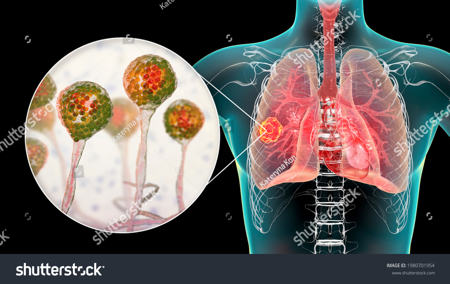 Lung Mucormycosis Lung Disease Caused By Stock Illustration 1980701954