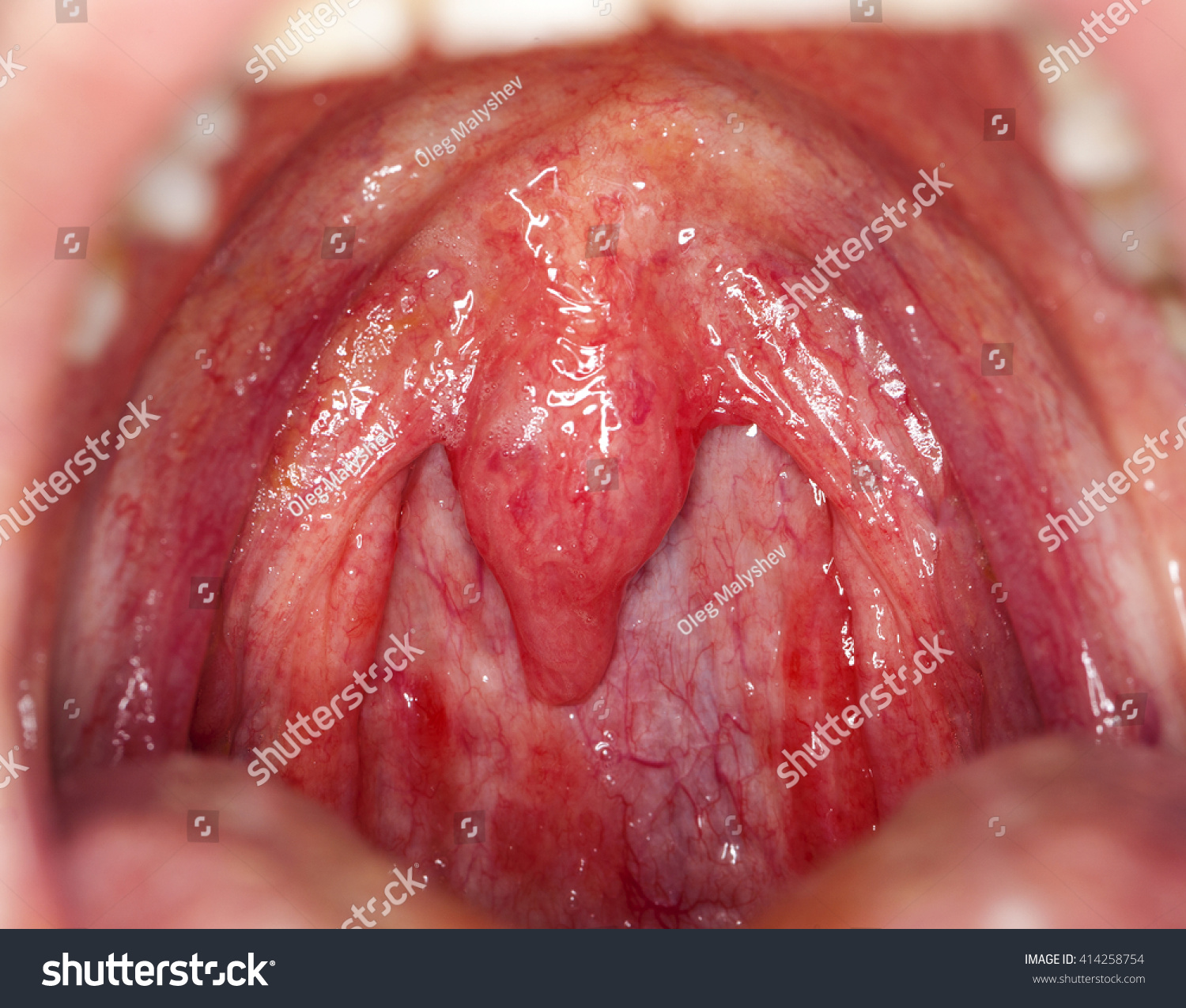 White Pattern On Tonsils | macro opened mouth throat tonsil stock photo 414258754 White Pattern On Tonsils | macro opened mouth throat tonsil stock photo 414258754