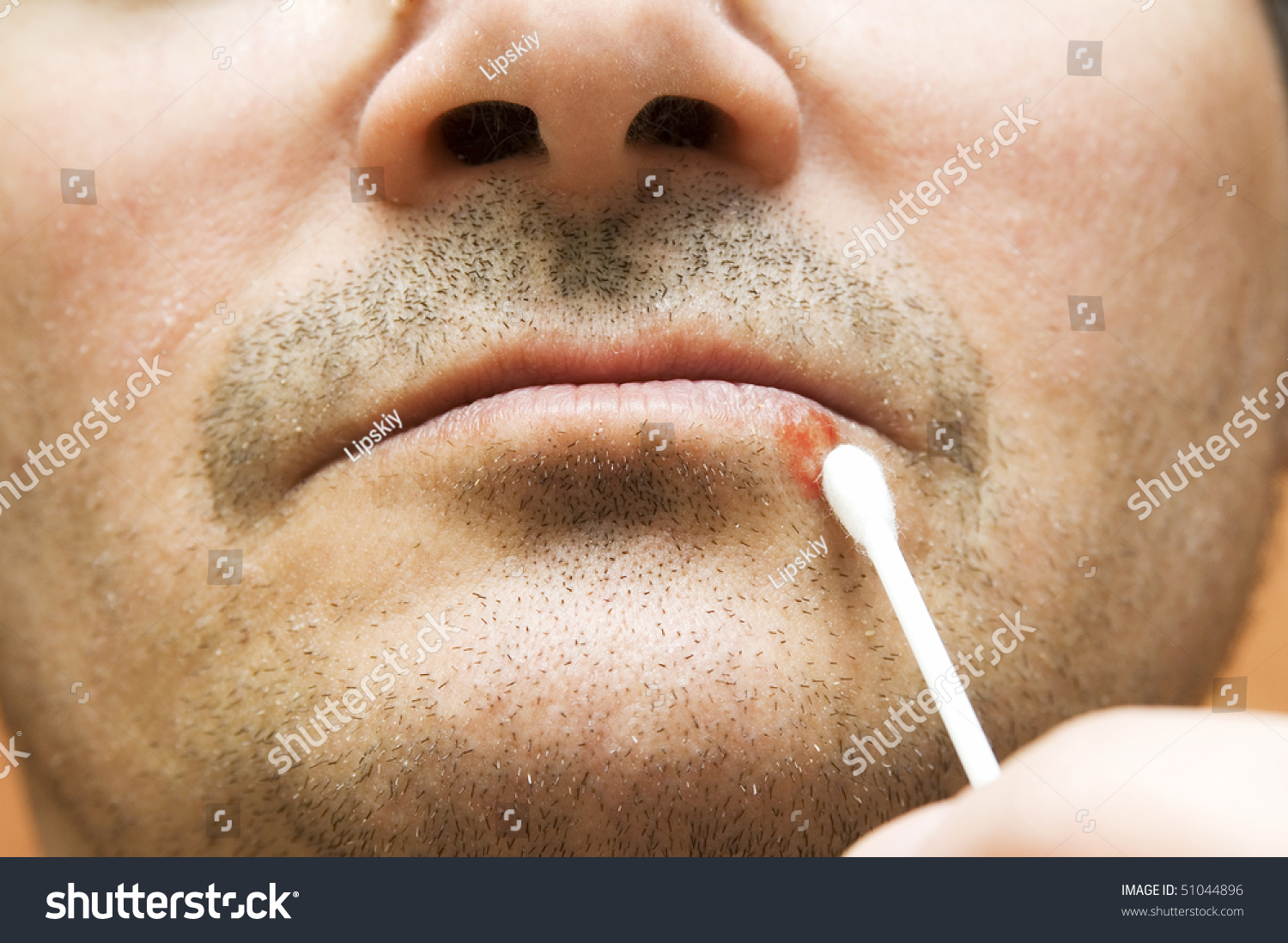 Dating a guy with cold sores