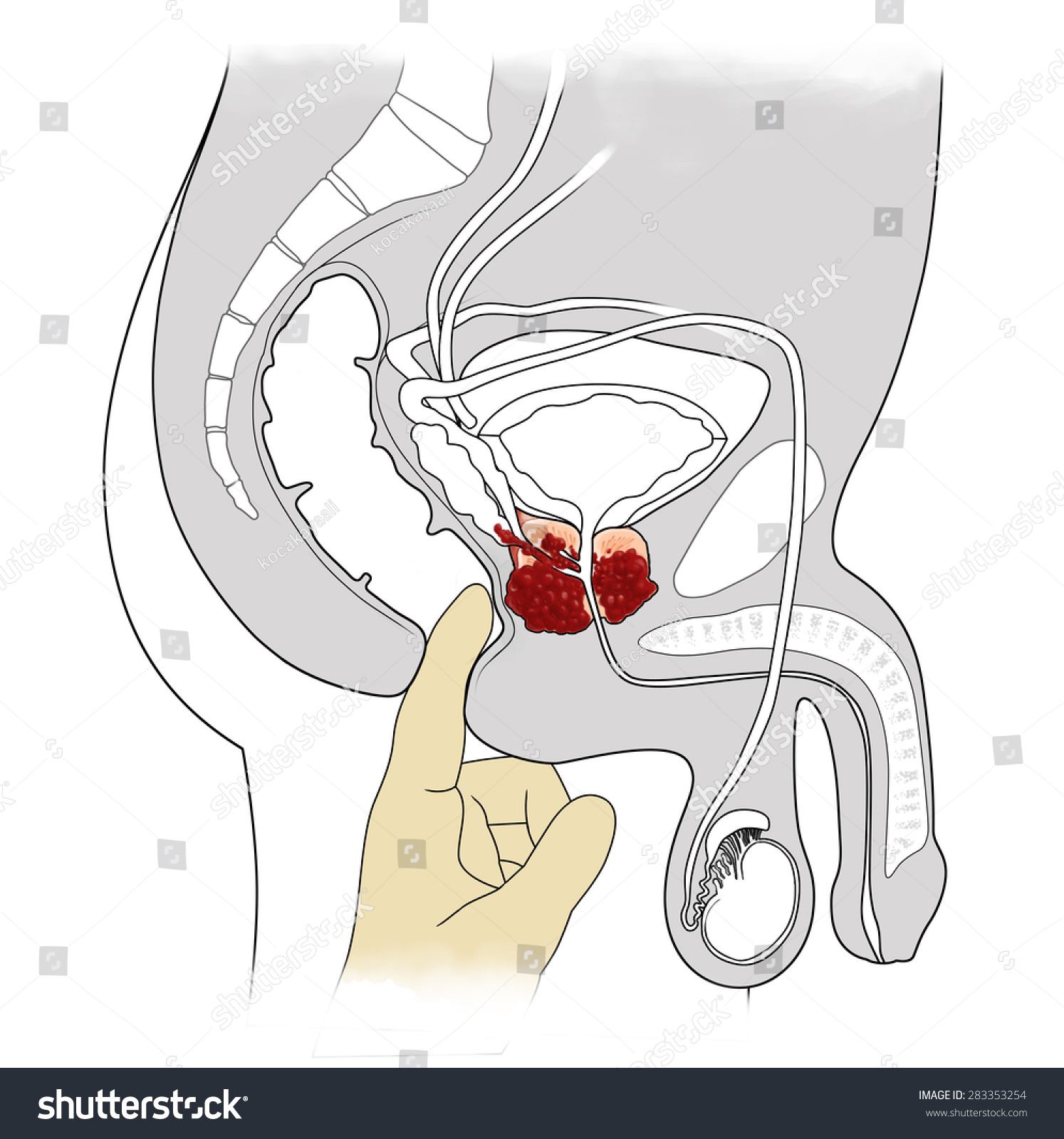 Prostatectomy Diagram