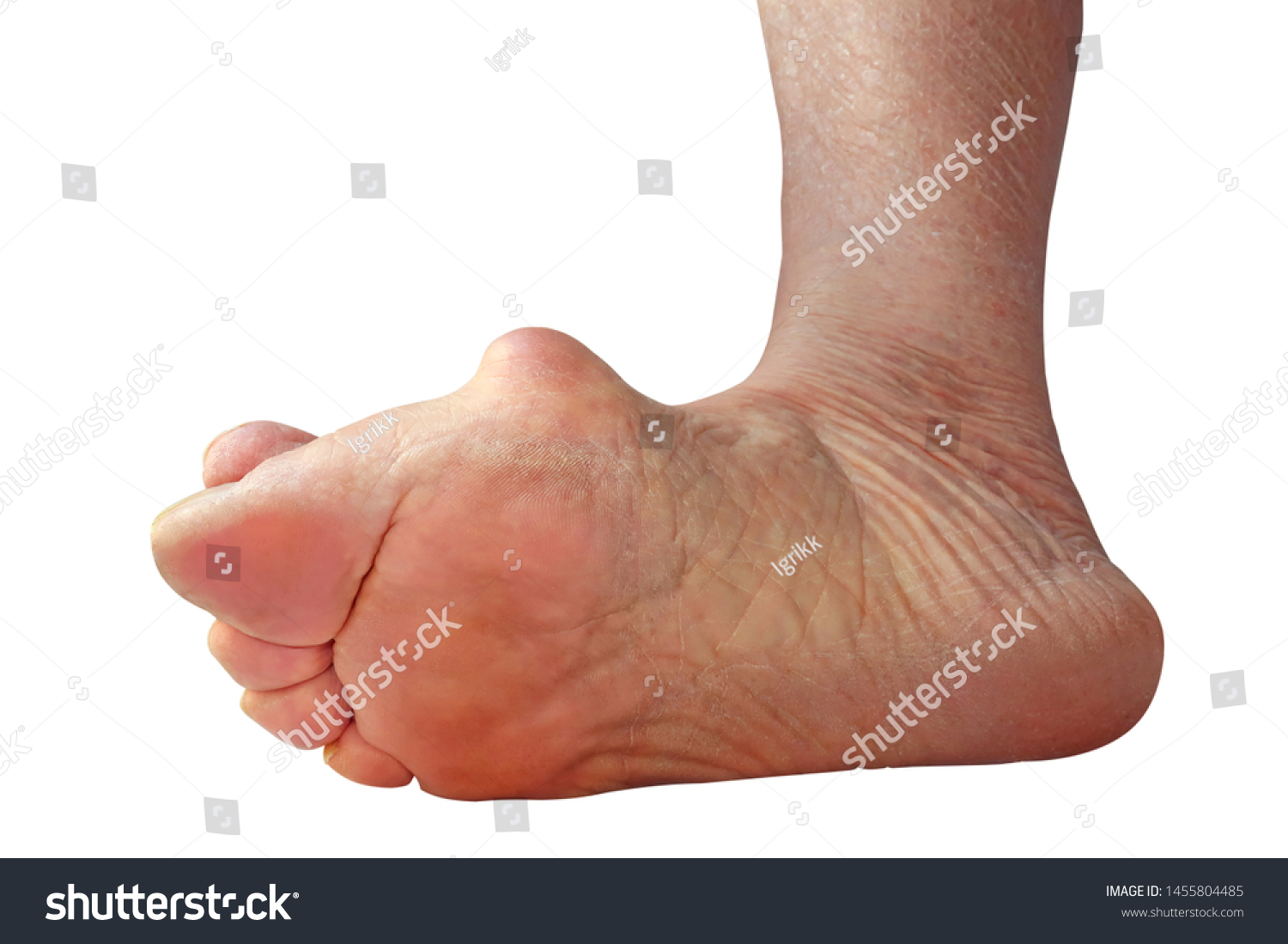 Medecin Valgus Bunion Leg Deformation Valgus Stock Photo