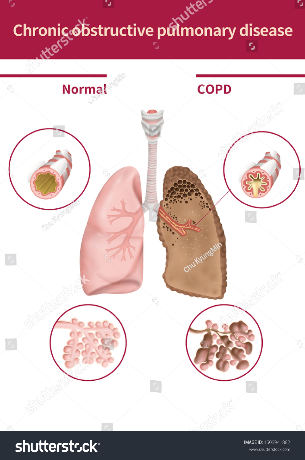 Ilustrasi Stok Medical Illustration Explain Chronic Obstructive Pulmonary Shutterstock