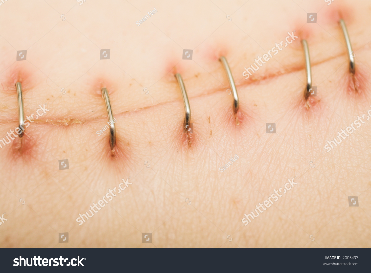 Metal Staples (Satures) In A Scar Left From A Laparotomy/Laparoscopy Â