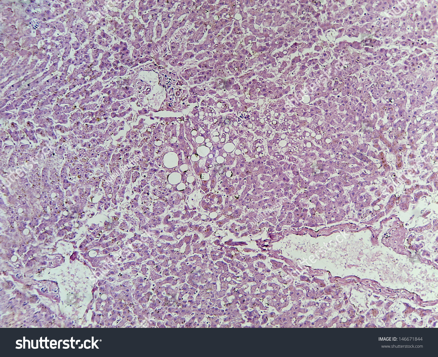 Micrograph Of Human Liver Tissue With Characteristic Vacuolization
