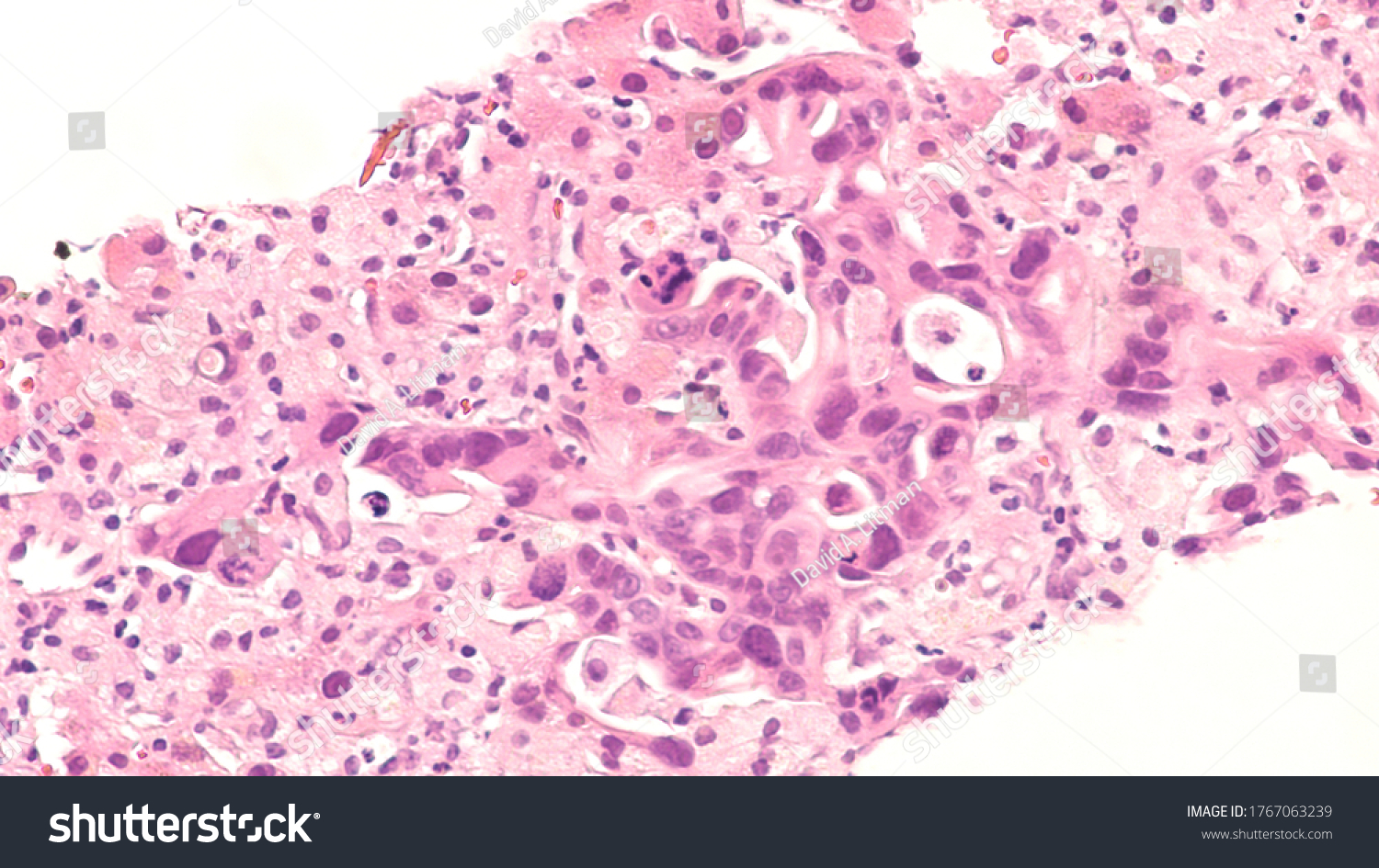 Microscopic Photograph Core Biopsy Liver Showing Stock Photo